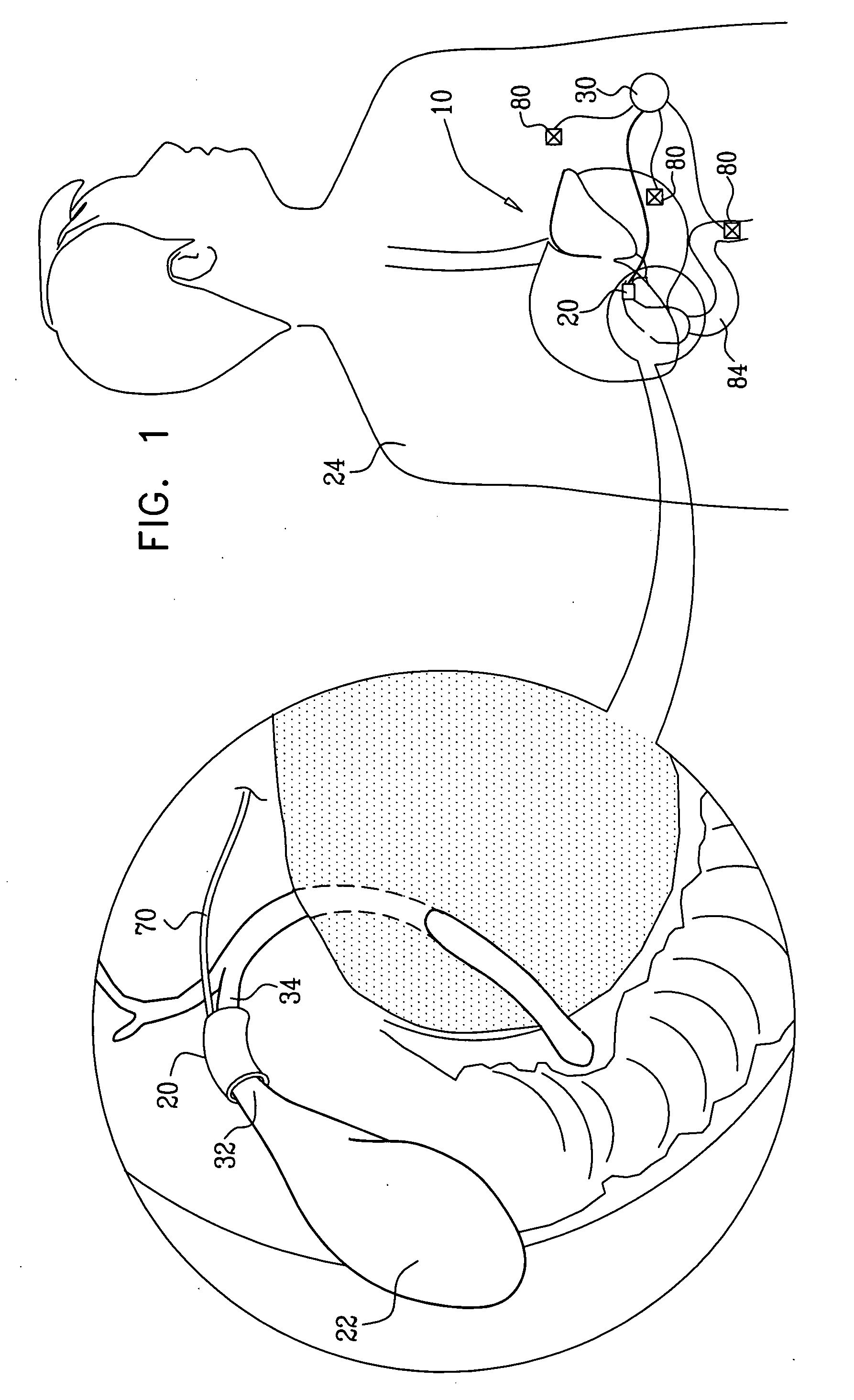 Techniques for gall bladder stimulation