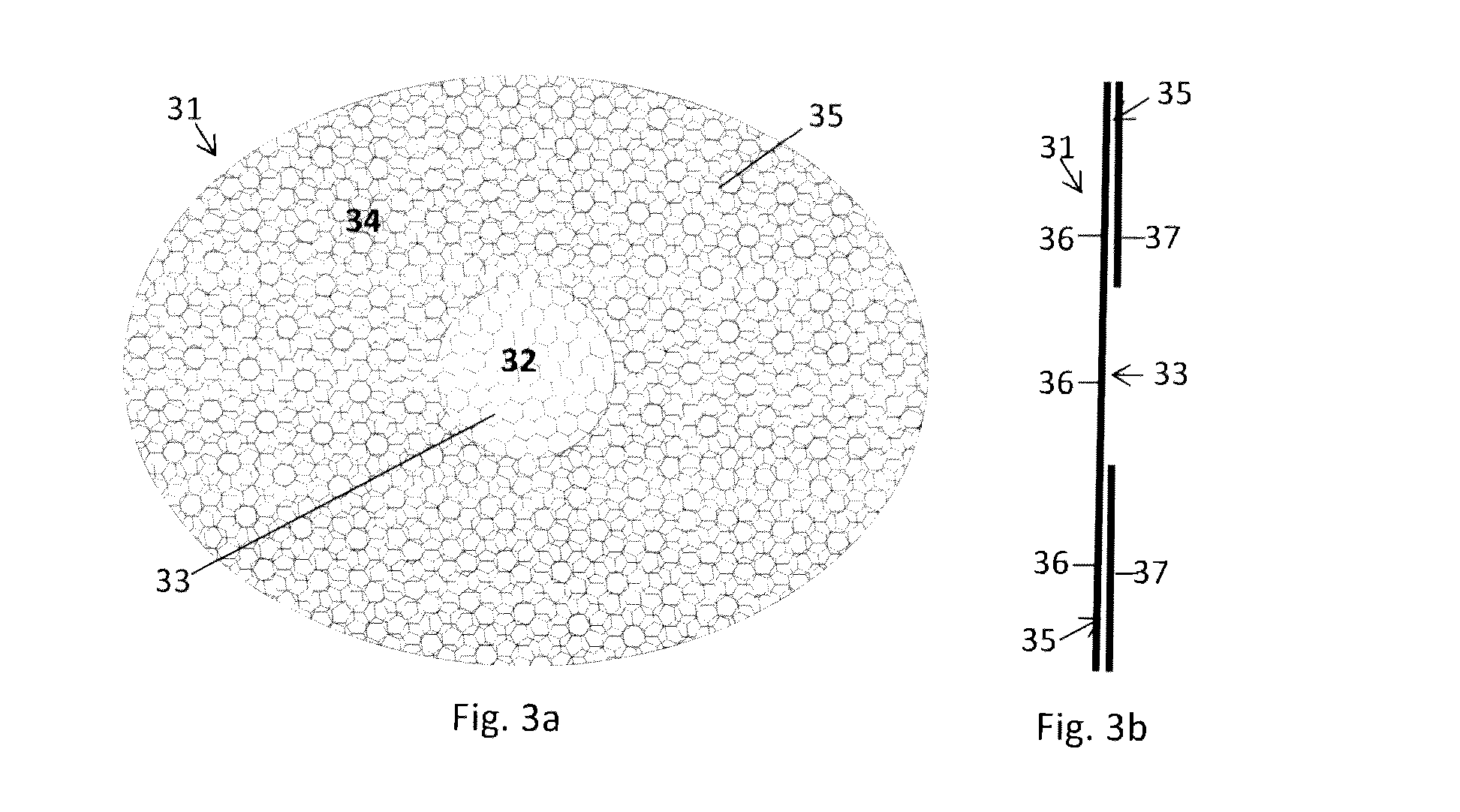 Resorbable medical mesh implant for repair or prevention of parastomal hernia