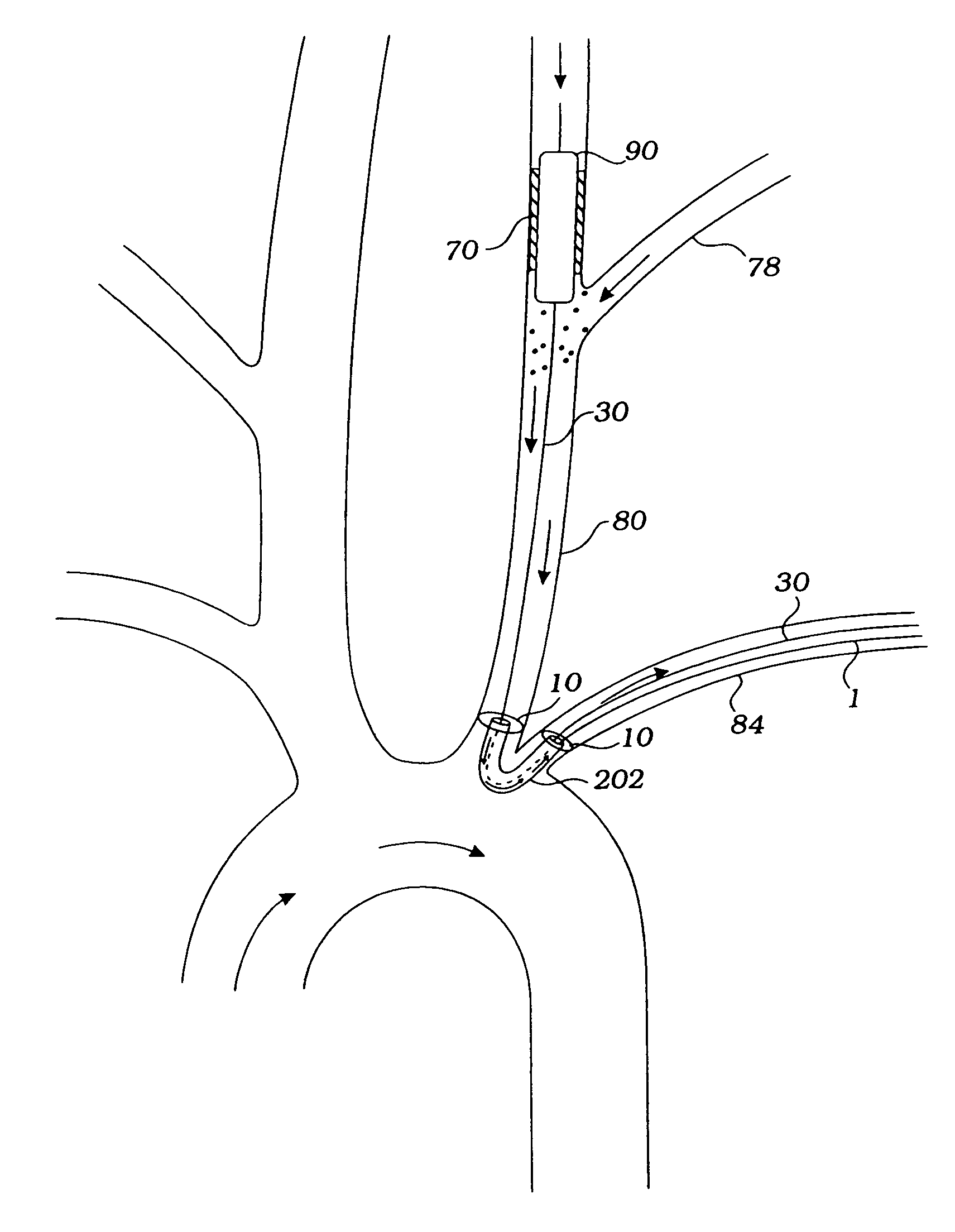 Devices and methods for preventing distal embolization using flow reversal by partial occlusion of the brachiocephalic artery