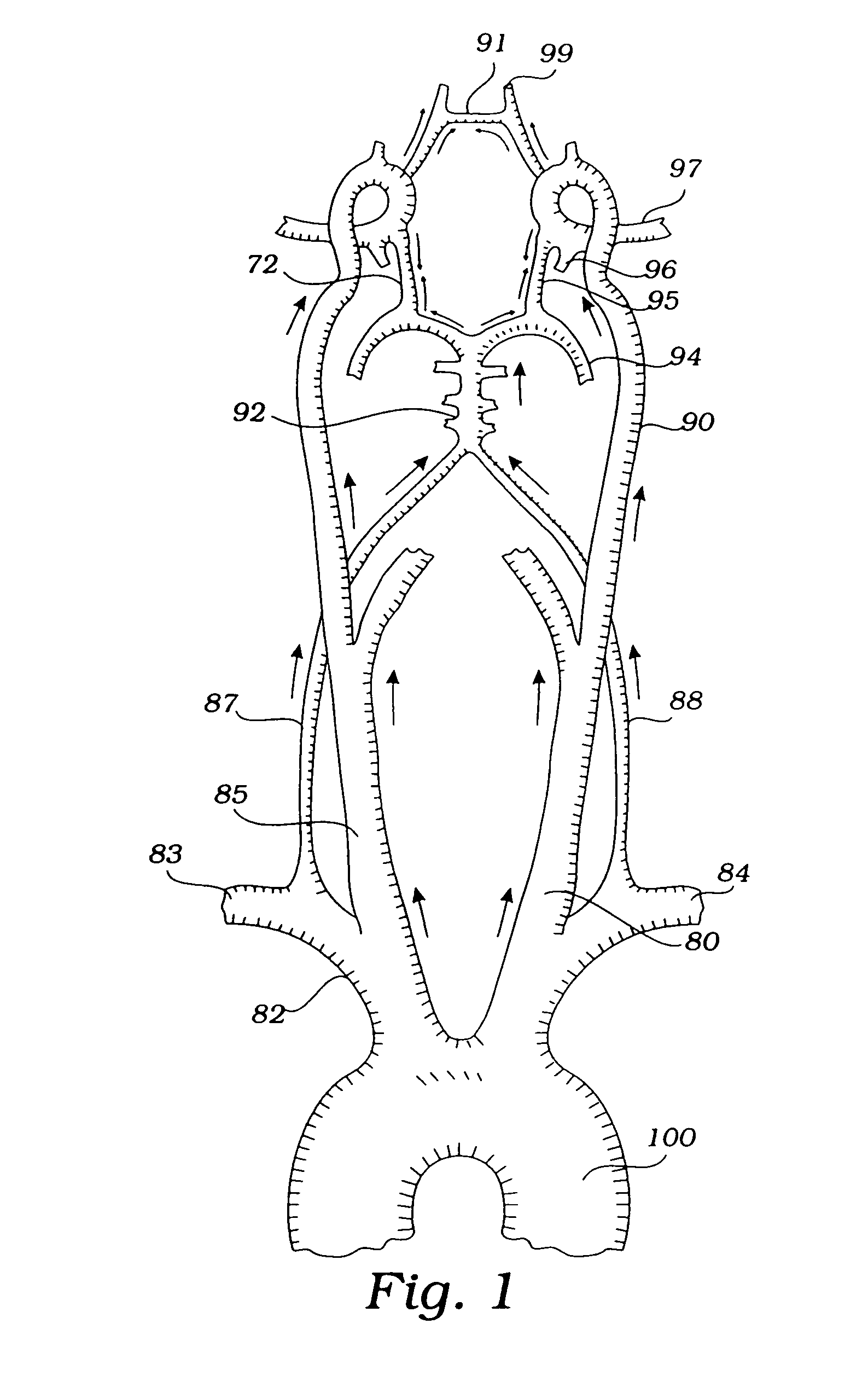 Devices and methods for preventing distal embolization using flow reversal by partial occlusion of the brachiocephalic artery