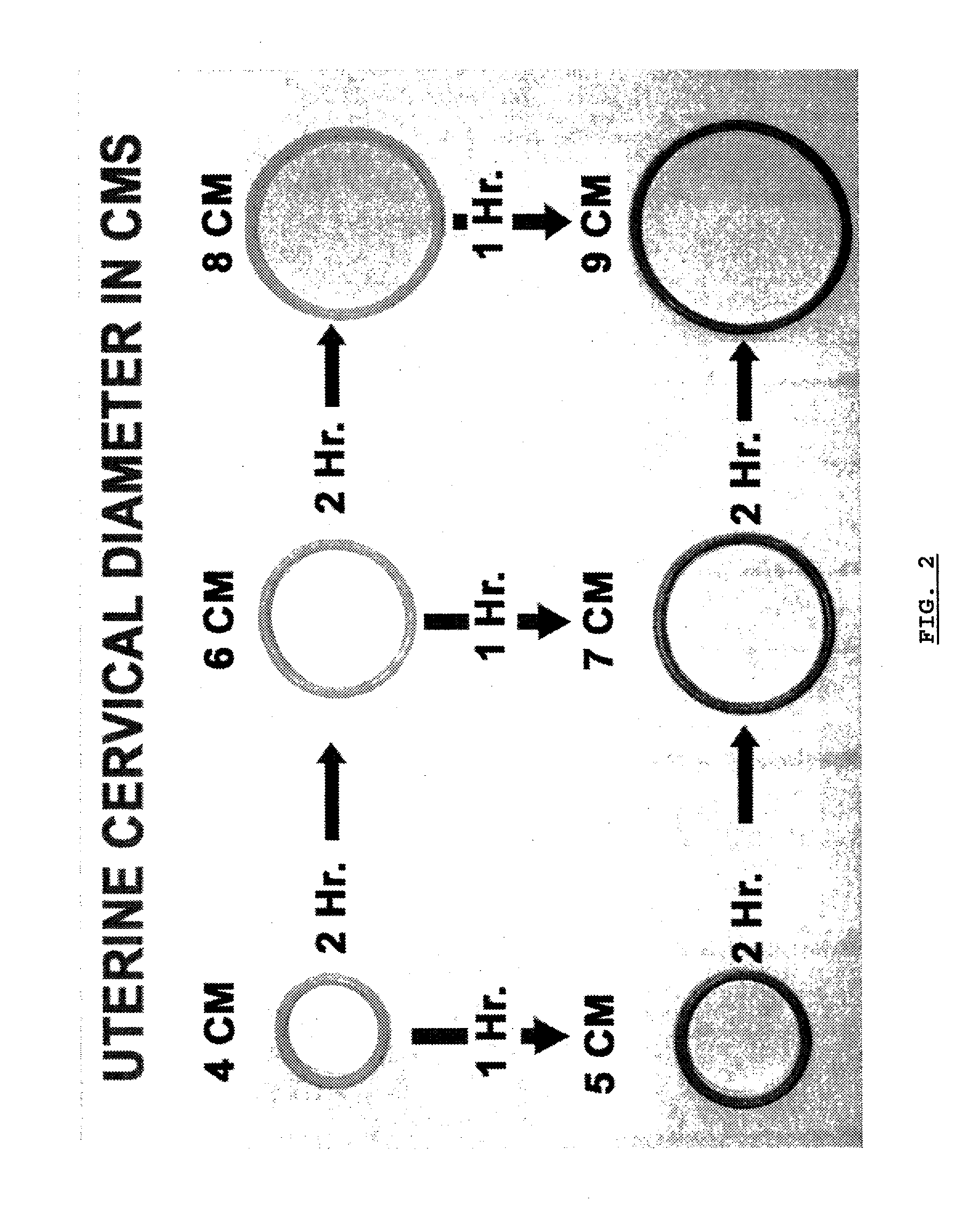 Color-coded rings for determining degree of cervical dilatation