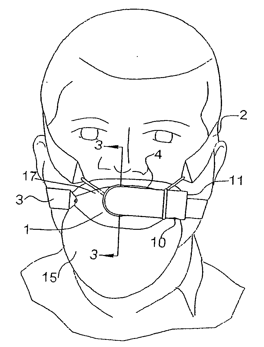 Mouthpiece, nasal seal, head appliance, apparatus, and methods of treating sleep apnea