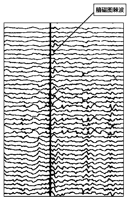 A method for automatic detection of epilepsy magnetoencephalogram spikes and a traceable positioning system