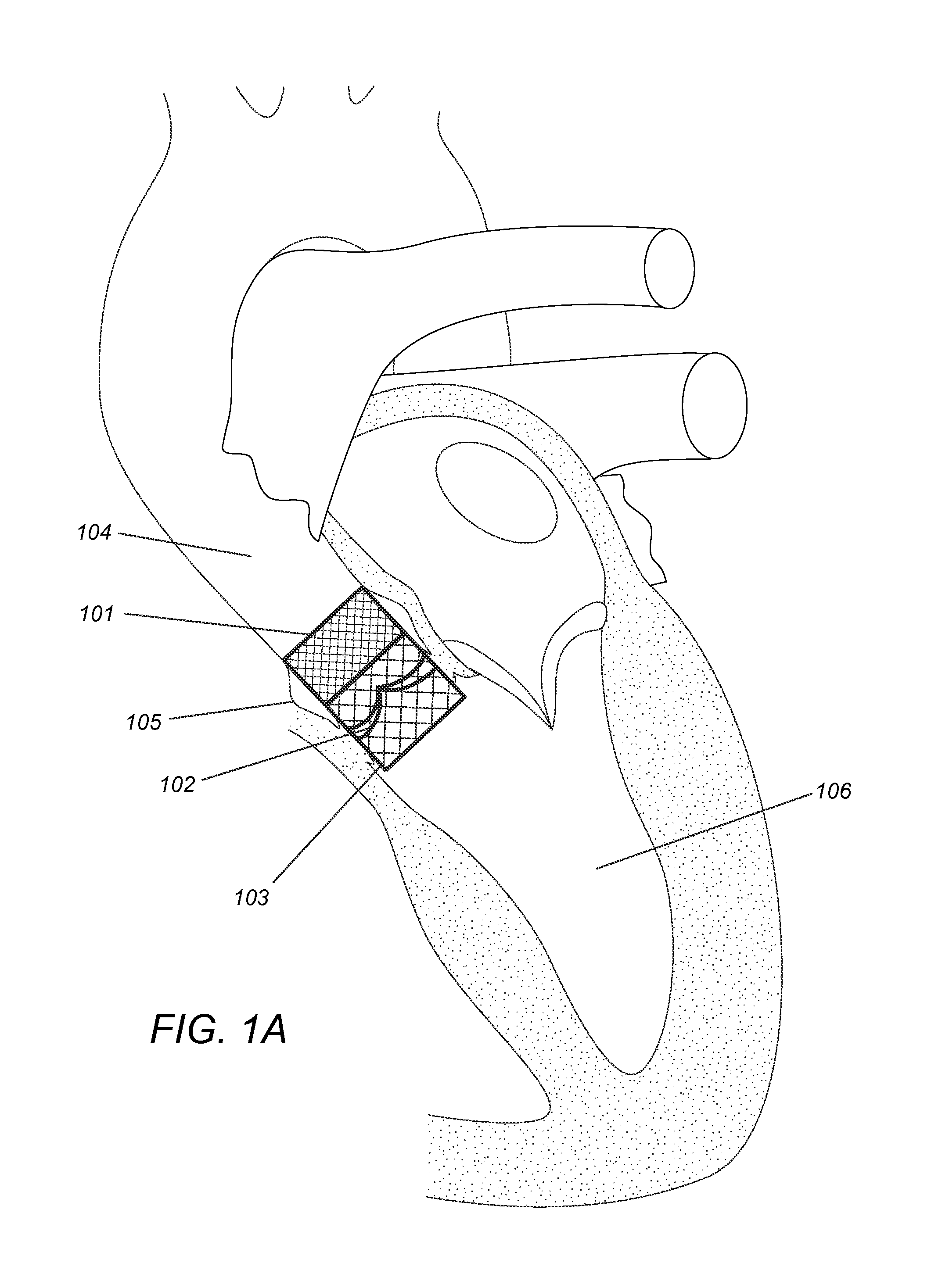 Modular dis-assembly of transcatheter valve replacement devices and uses thereof