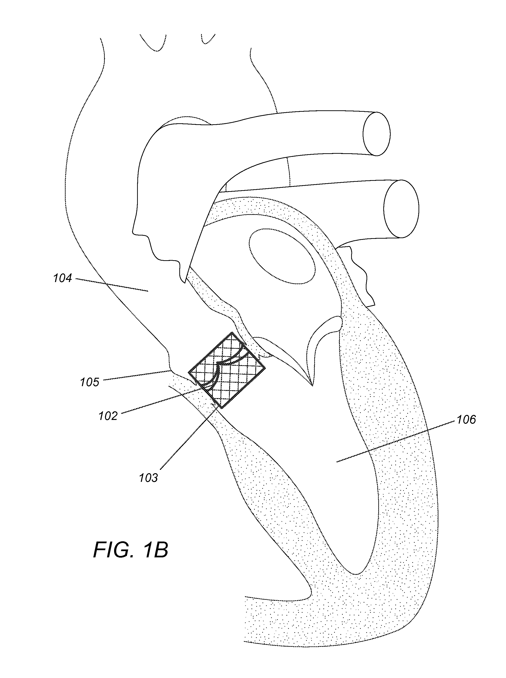 Modular dis-assembly of transcatheter valve replacement devices and uses thereof