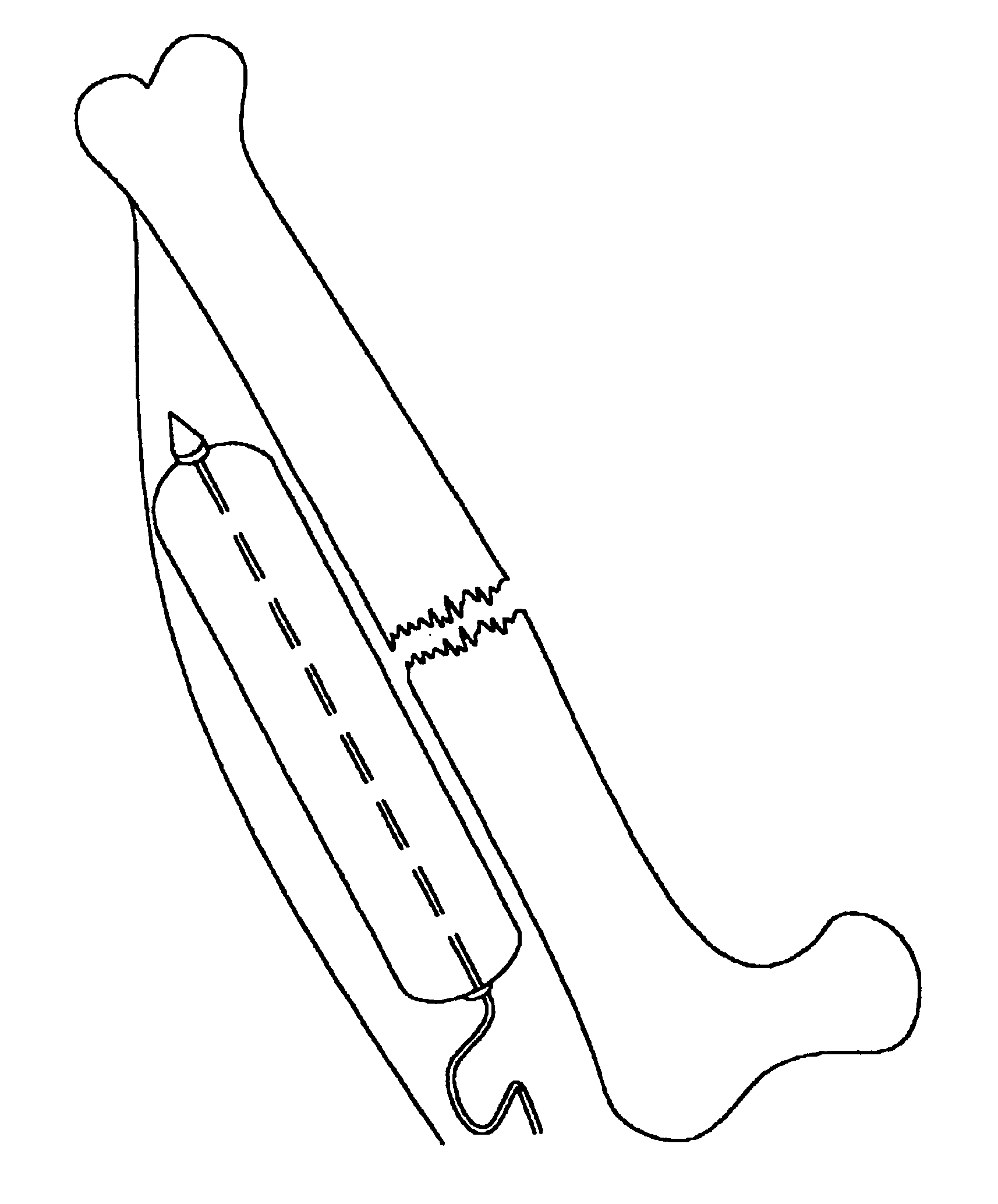 Percutaneous tissue dissection