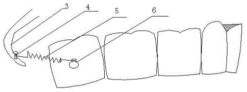 Molar distantly-moving device