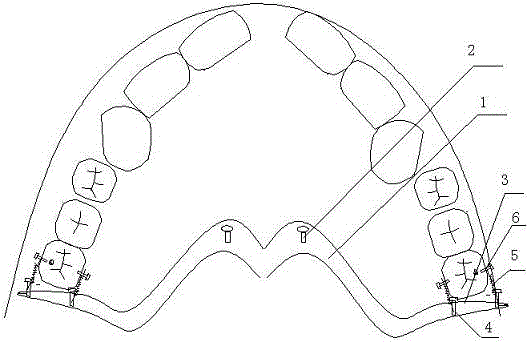 Molar distantly-moving device