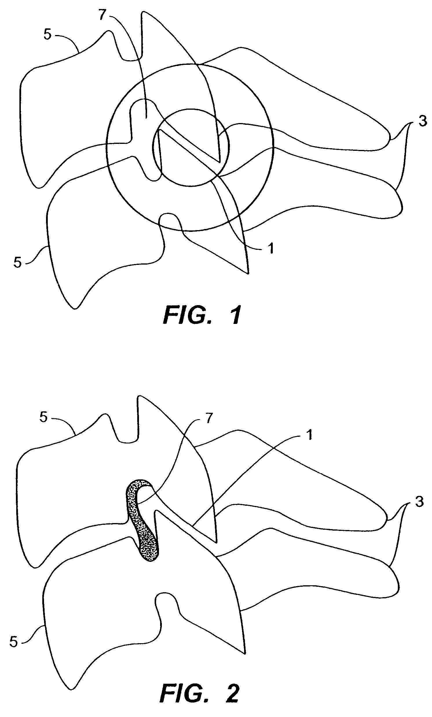 Inter-cervical facet implant with surface enhancements