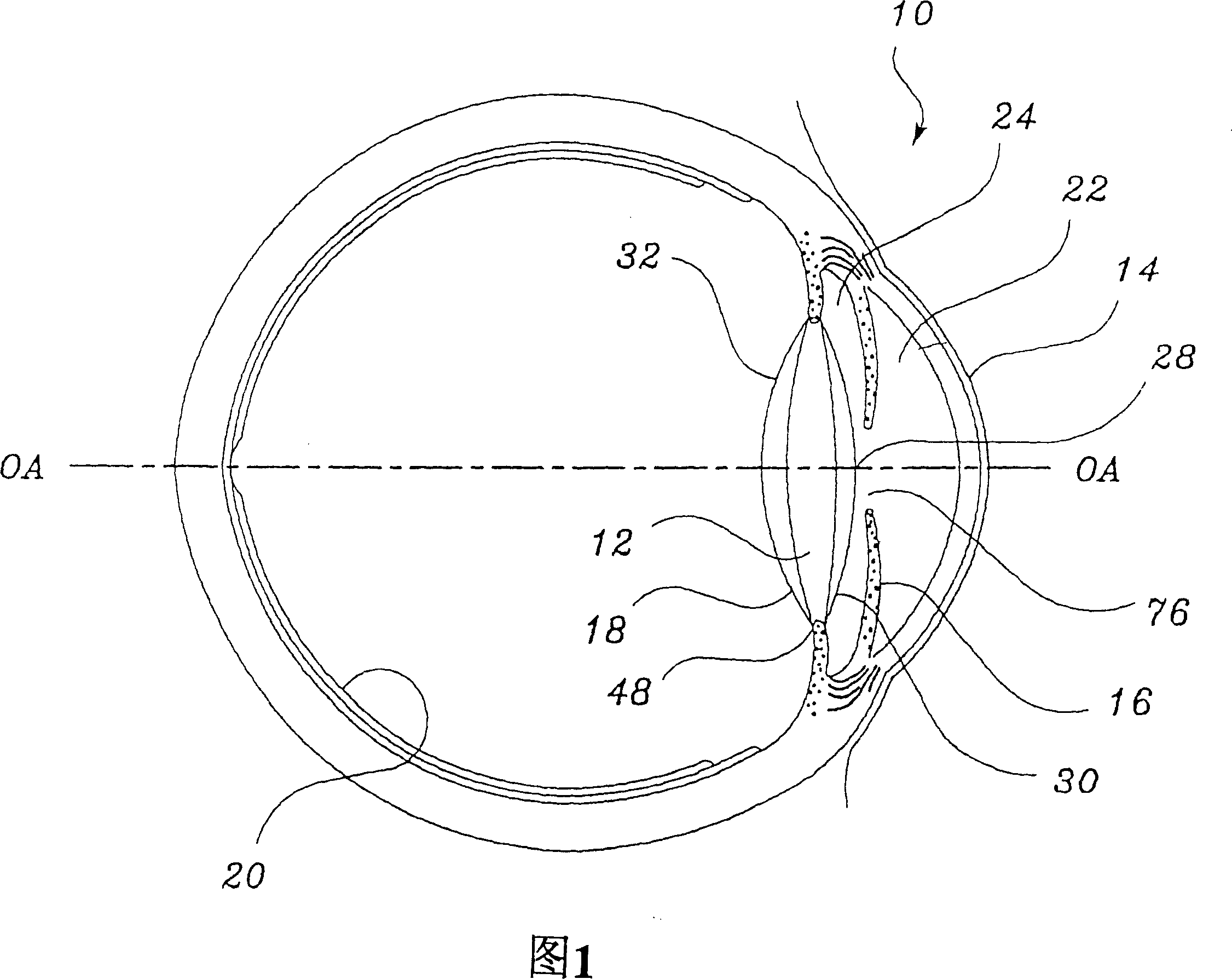 Intraocular lenses provided with angled edges to prevent posterior capsular opacification