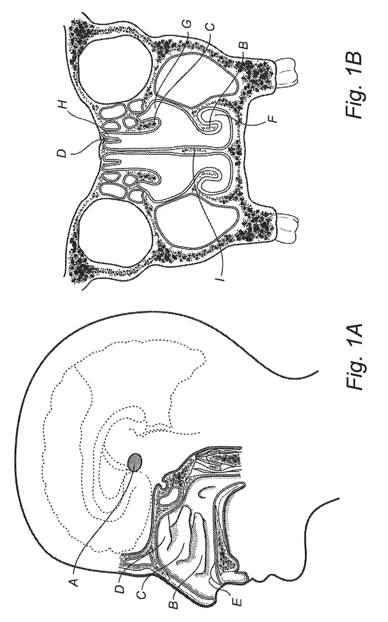 Stimulation of hypothalamus