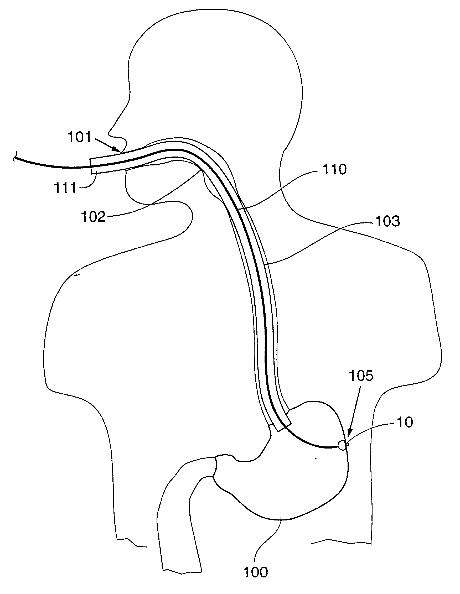 Gastric treatment and diagnosis device and method