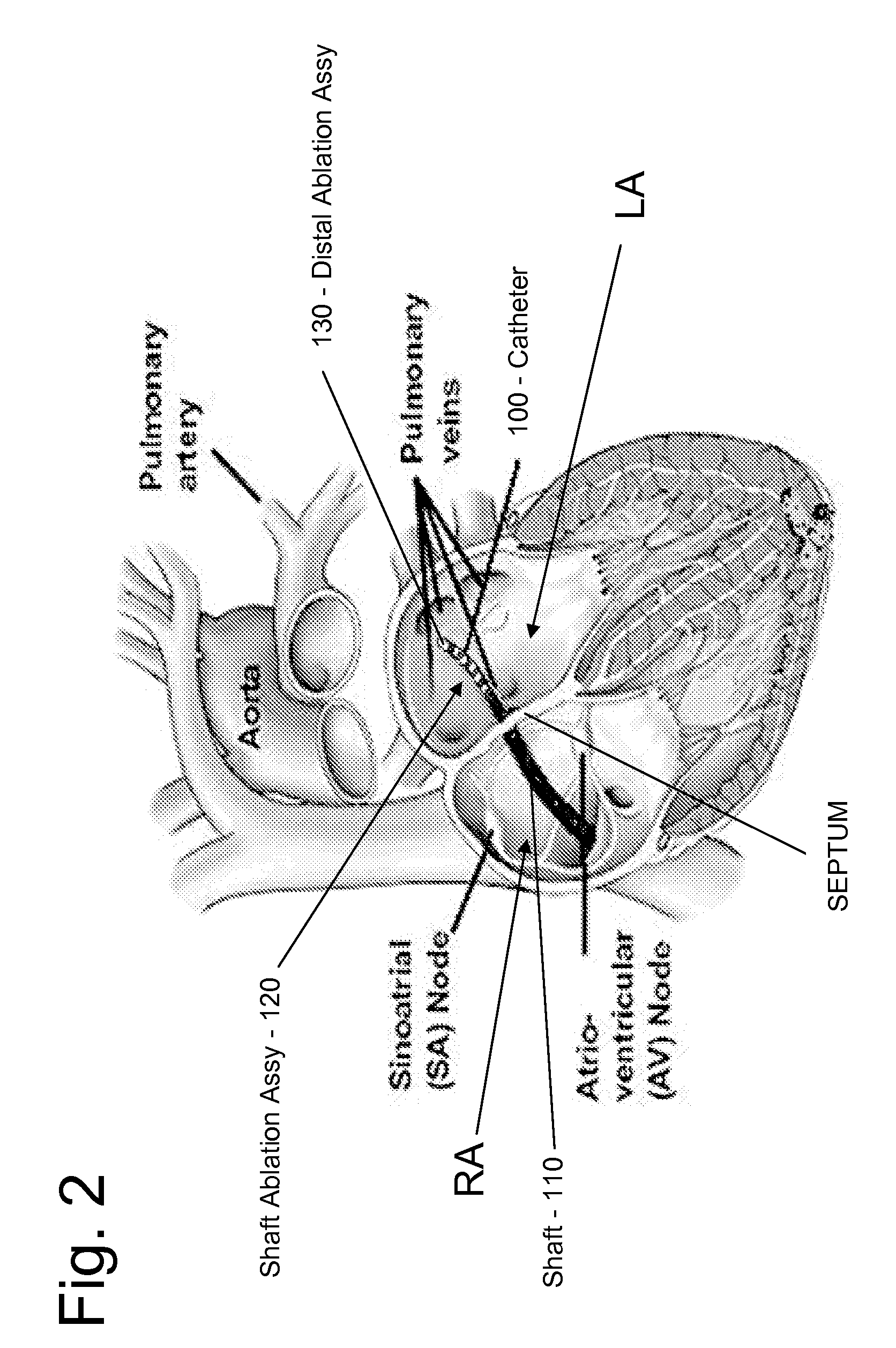 Irrigated Ablation Catheter System and Methods