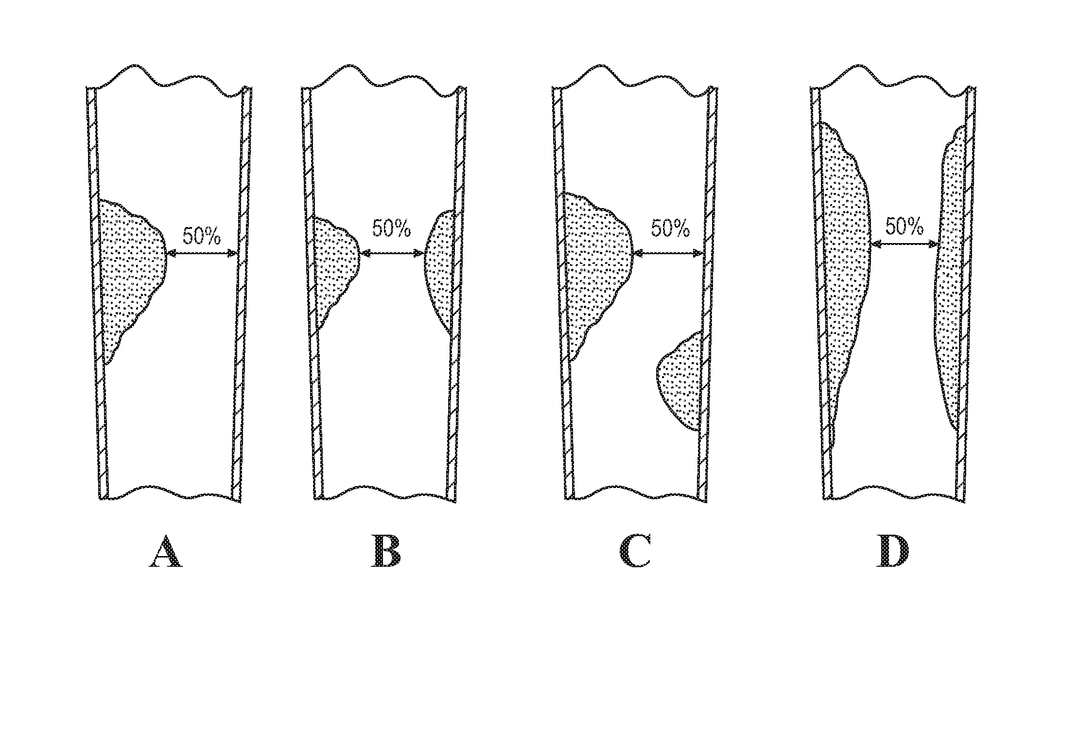 Method for assessing stenosis severity in a lesion tree through stenosis mapping