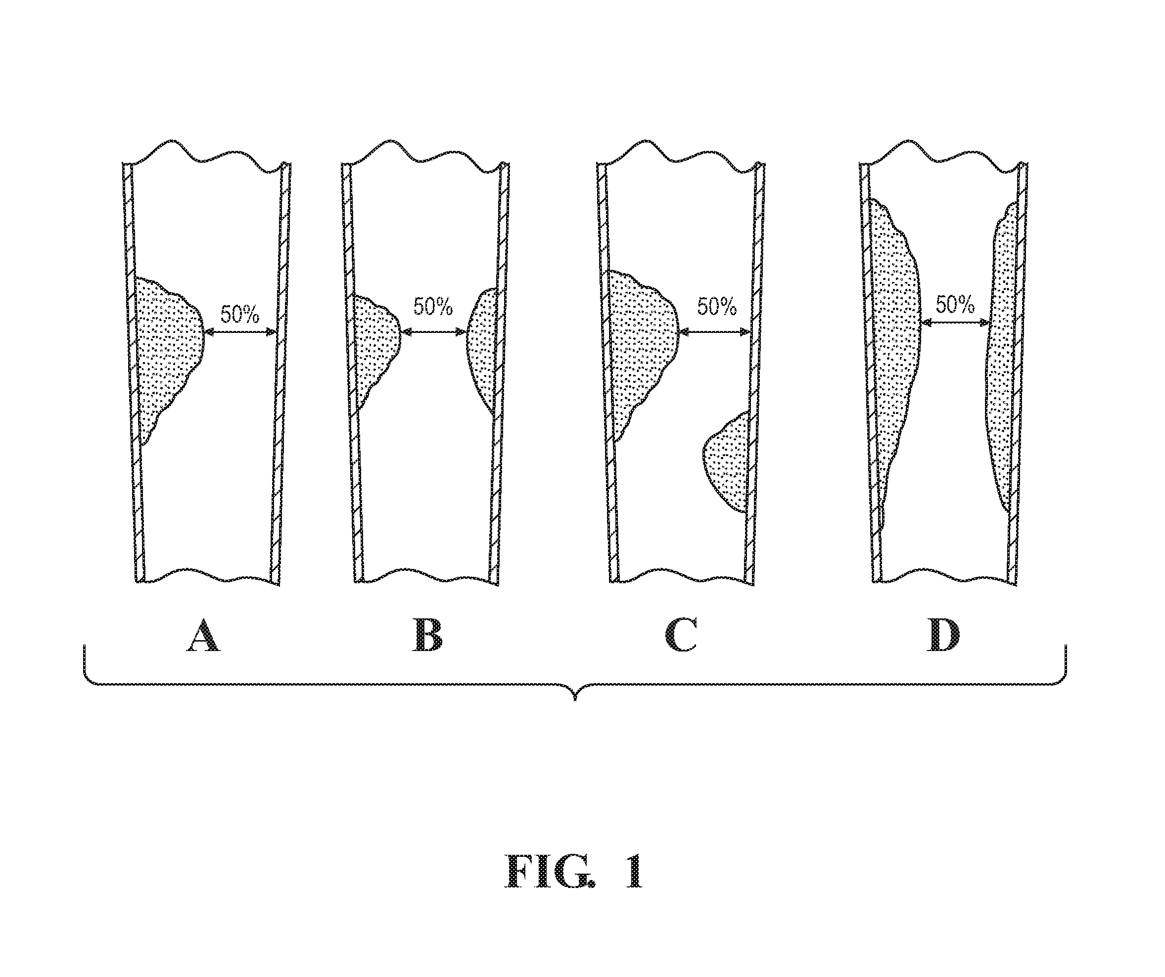 Method for assessing stenosis severity in a lesion tree through stenosis mapping