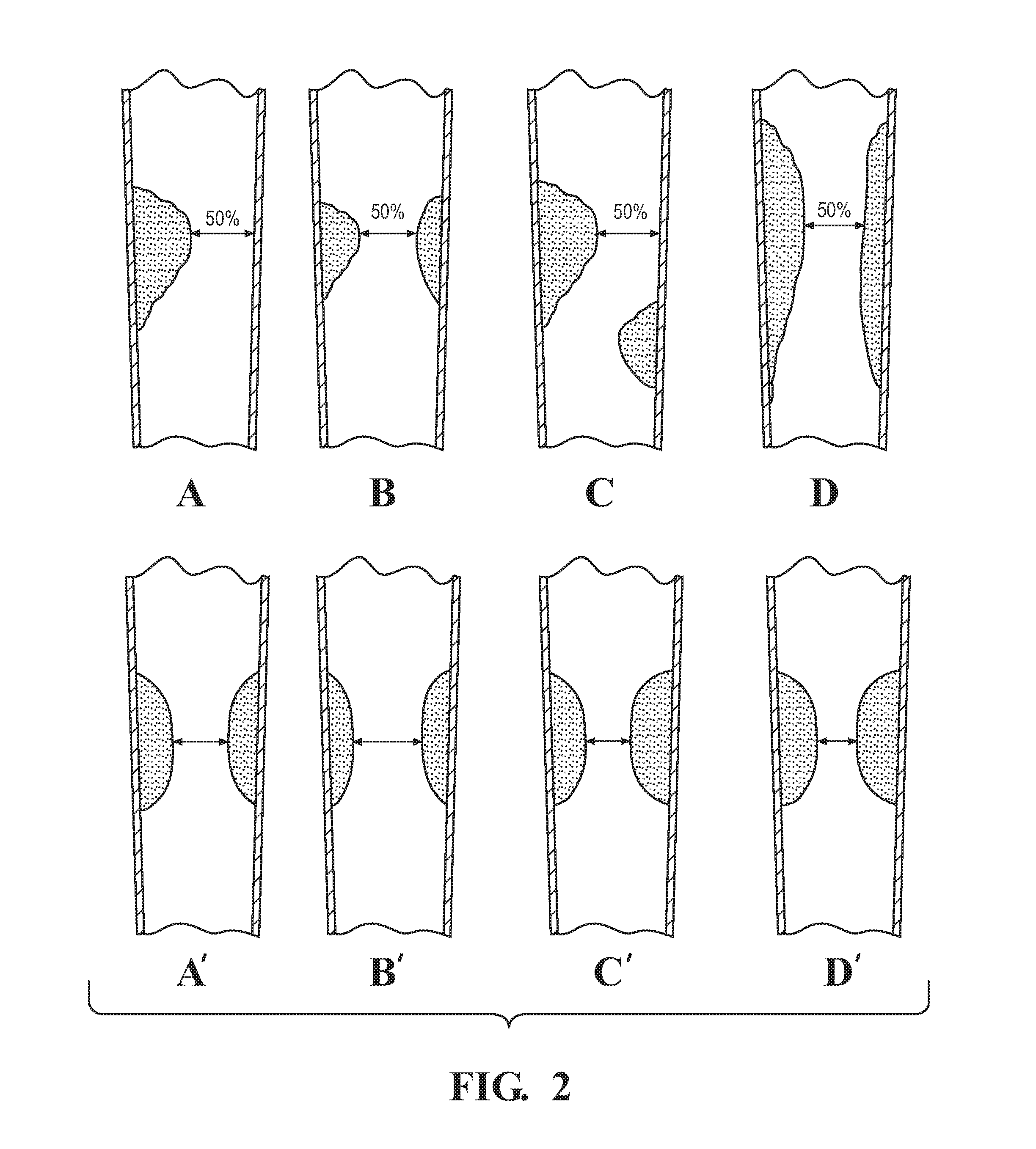 Method for assessing stenosis severity in a lesion tree through stenosis mapping