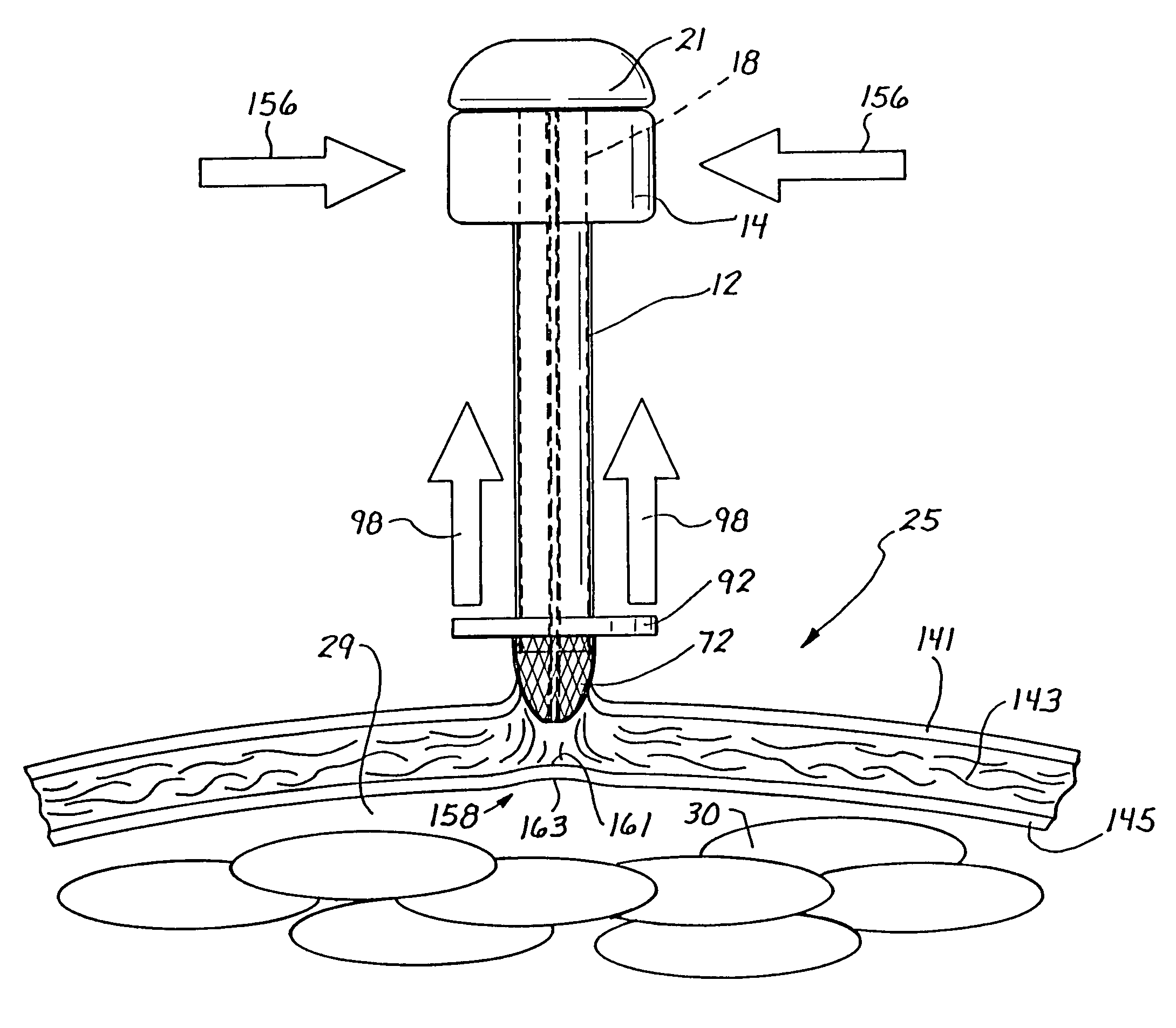 Traction trocar apparatus and method