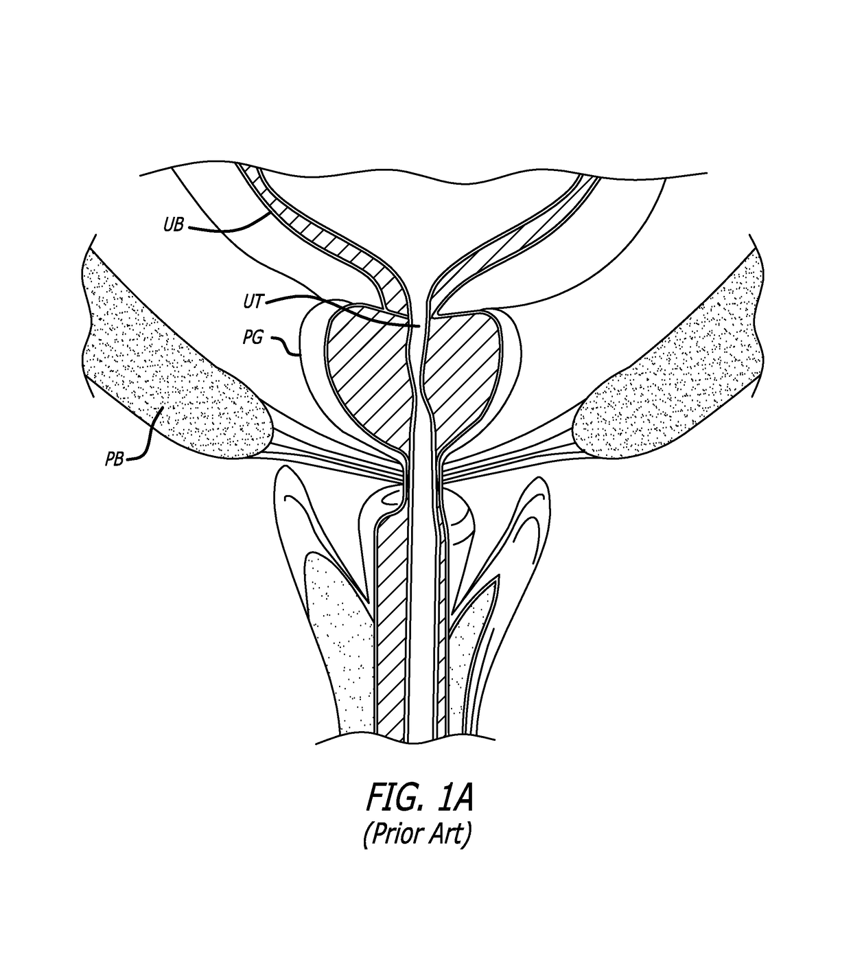 System for delivering an anchor