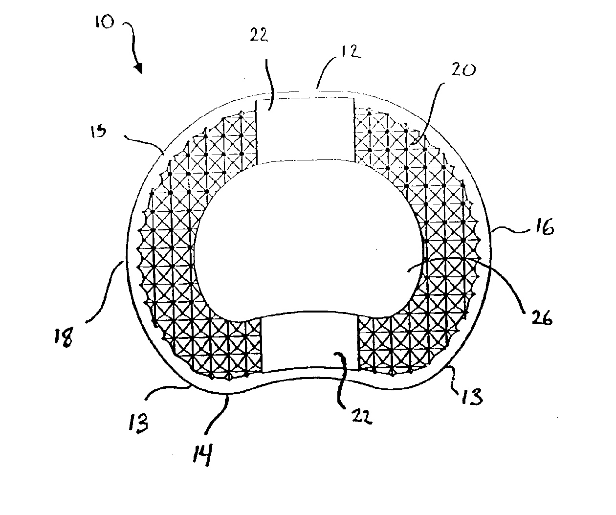 Intervertebral Implant