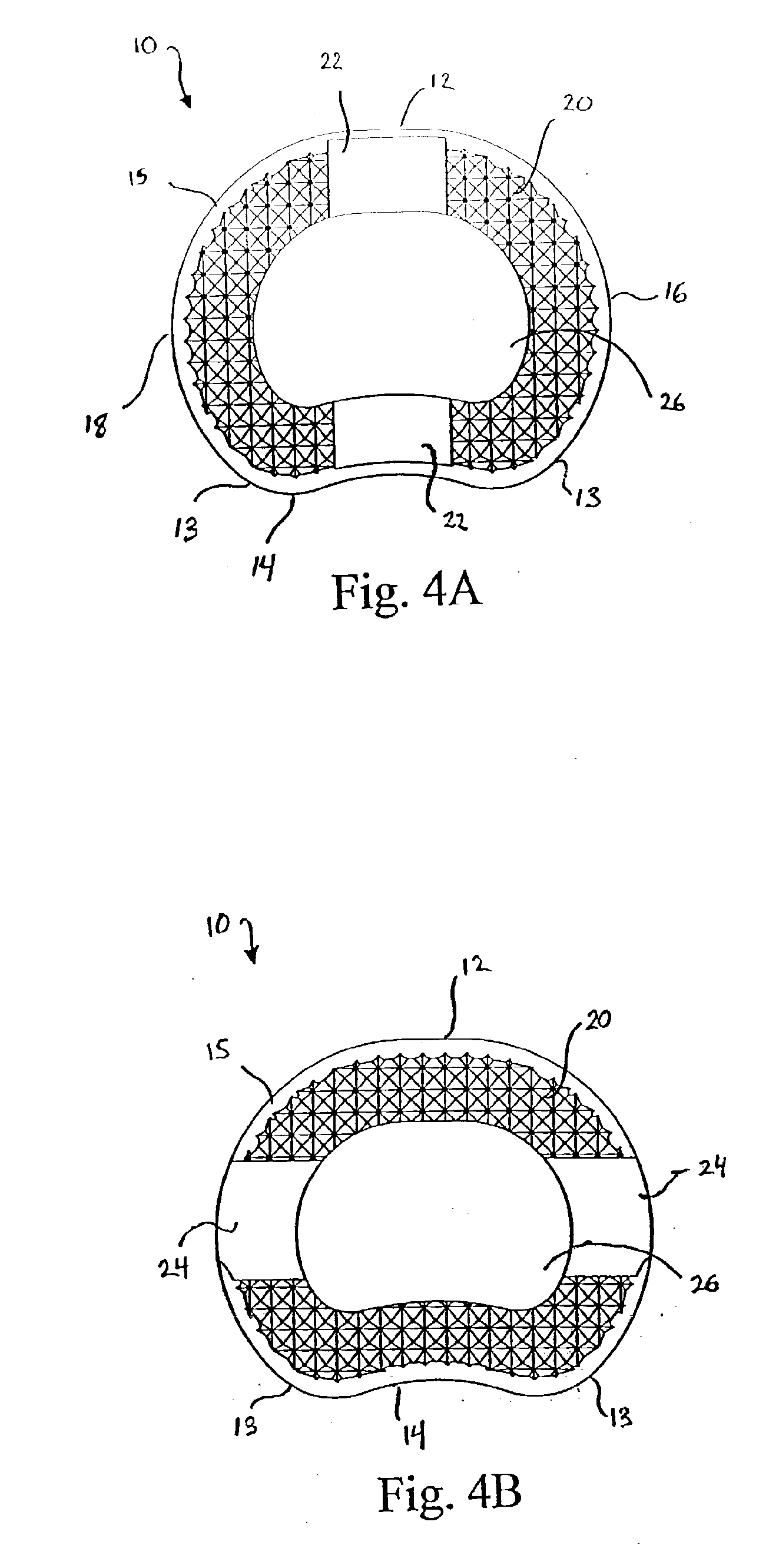 Intervertebral Implant