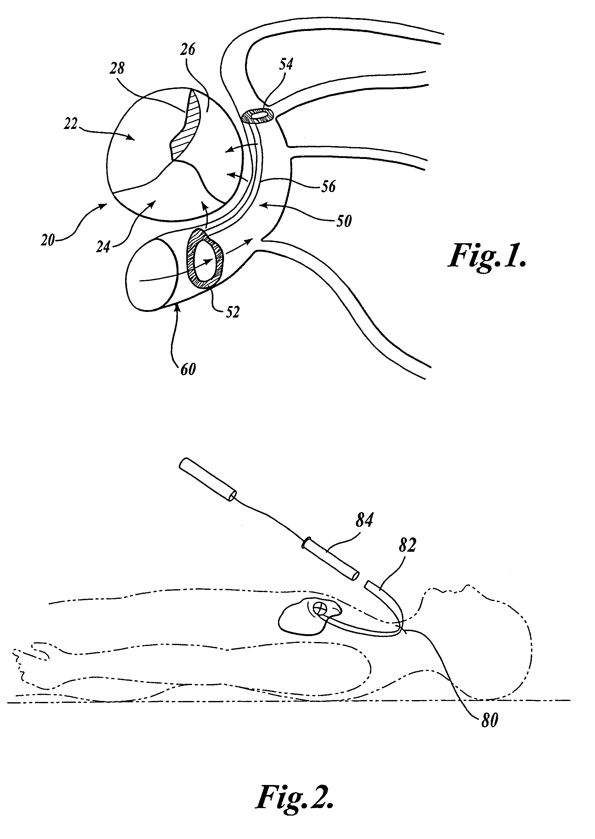 Device and method for modifying the shape of a body organ