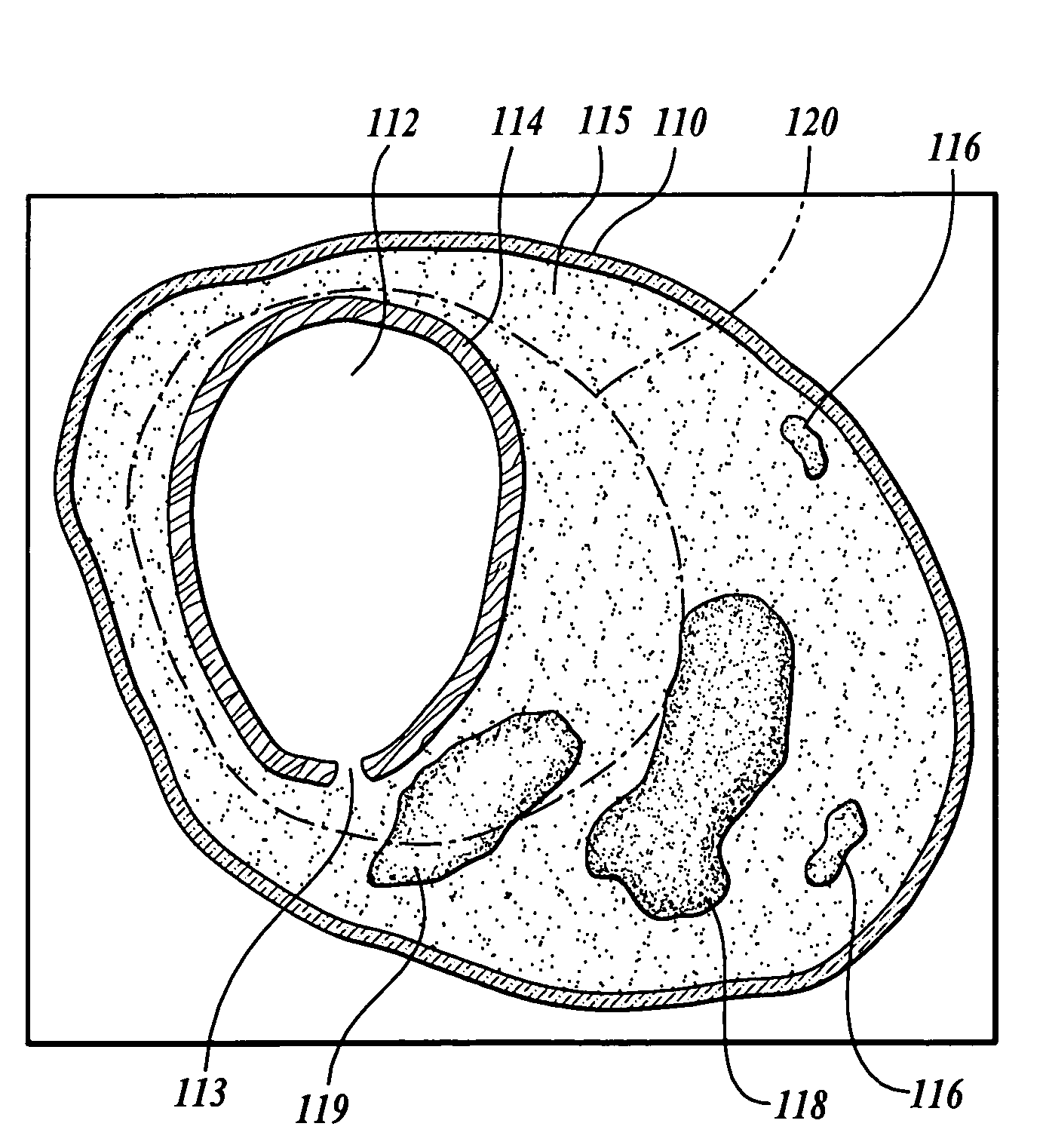 Method and system for atherosclerosis risk scoring