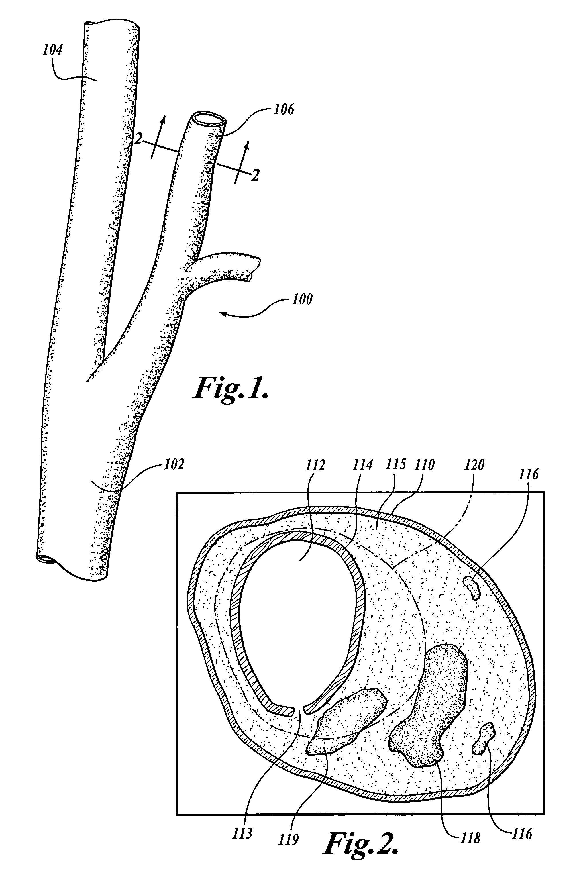 Method and system for atherosclerosis risk scoring