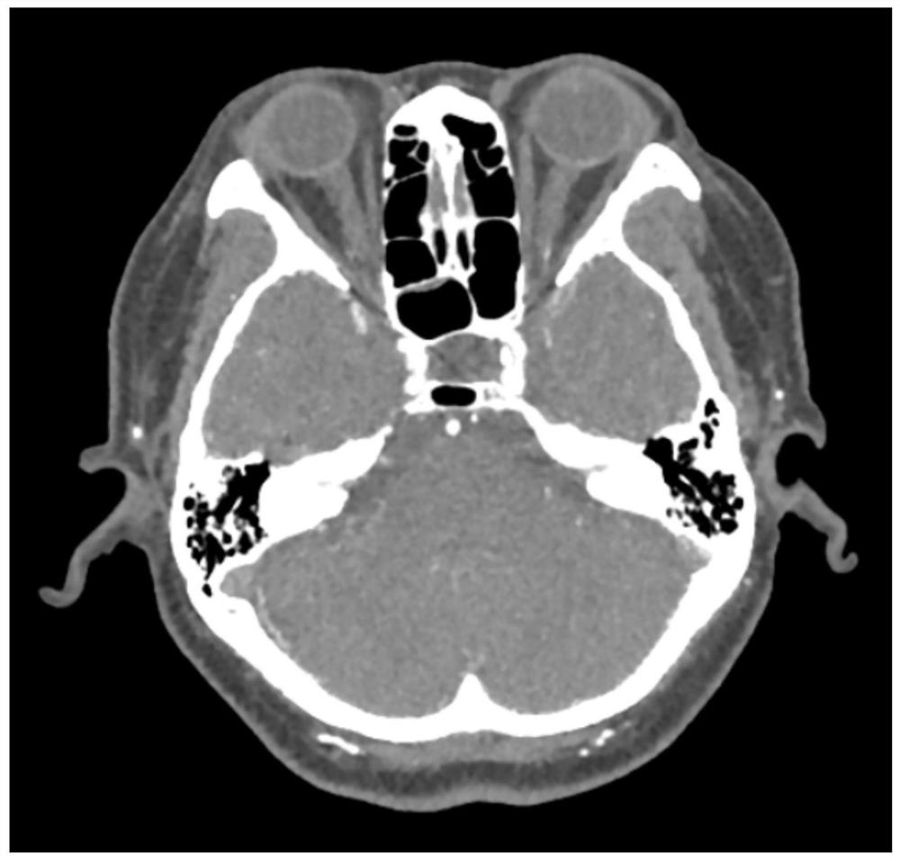 Intracranial aneurysm recognition and detection method, device and system and the computer readable storage medium