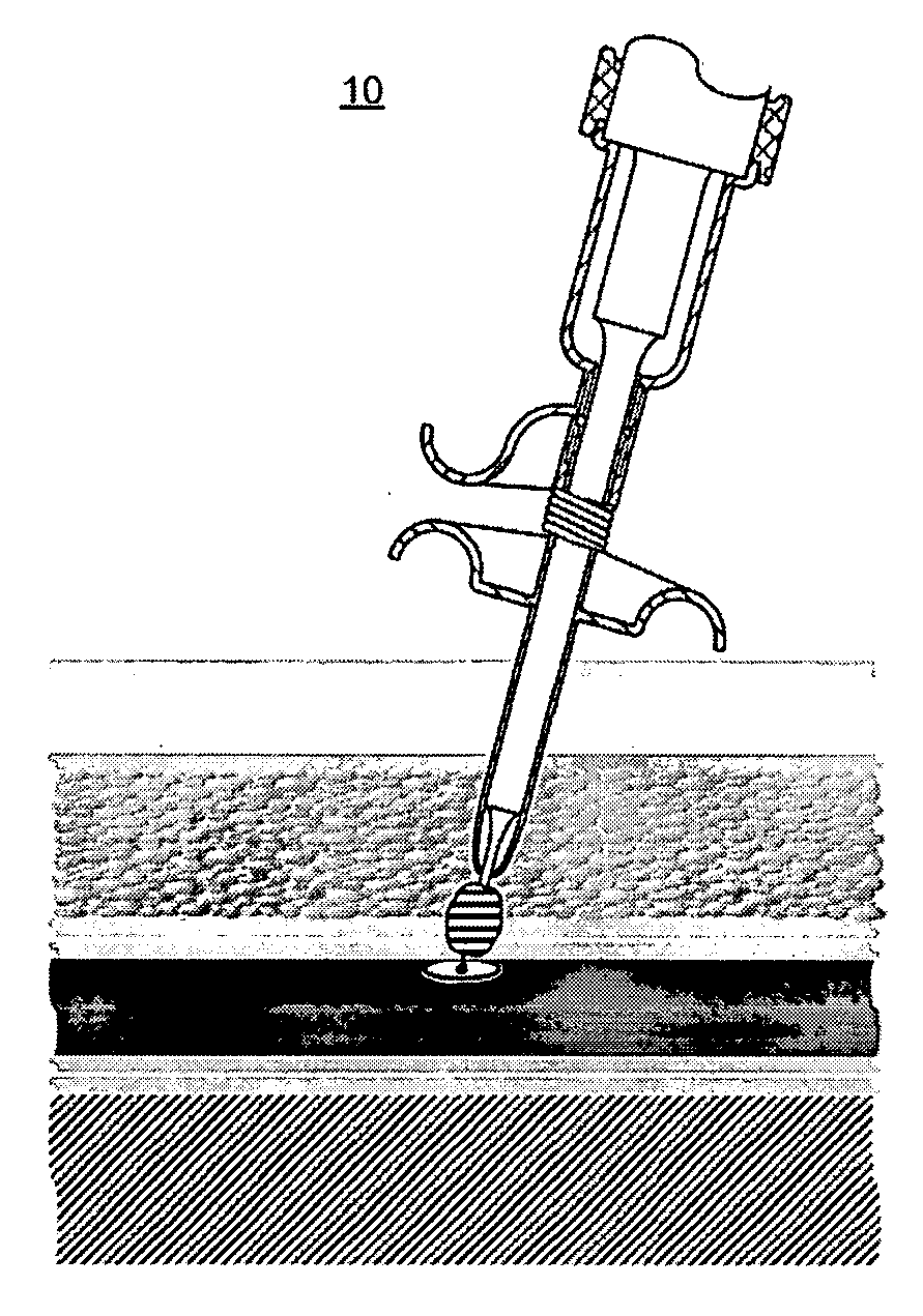 Ultrasonic vascular closure device