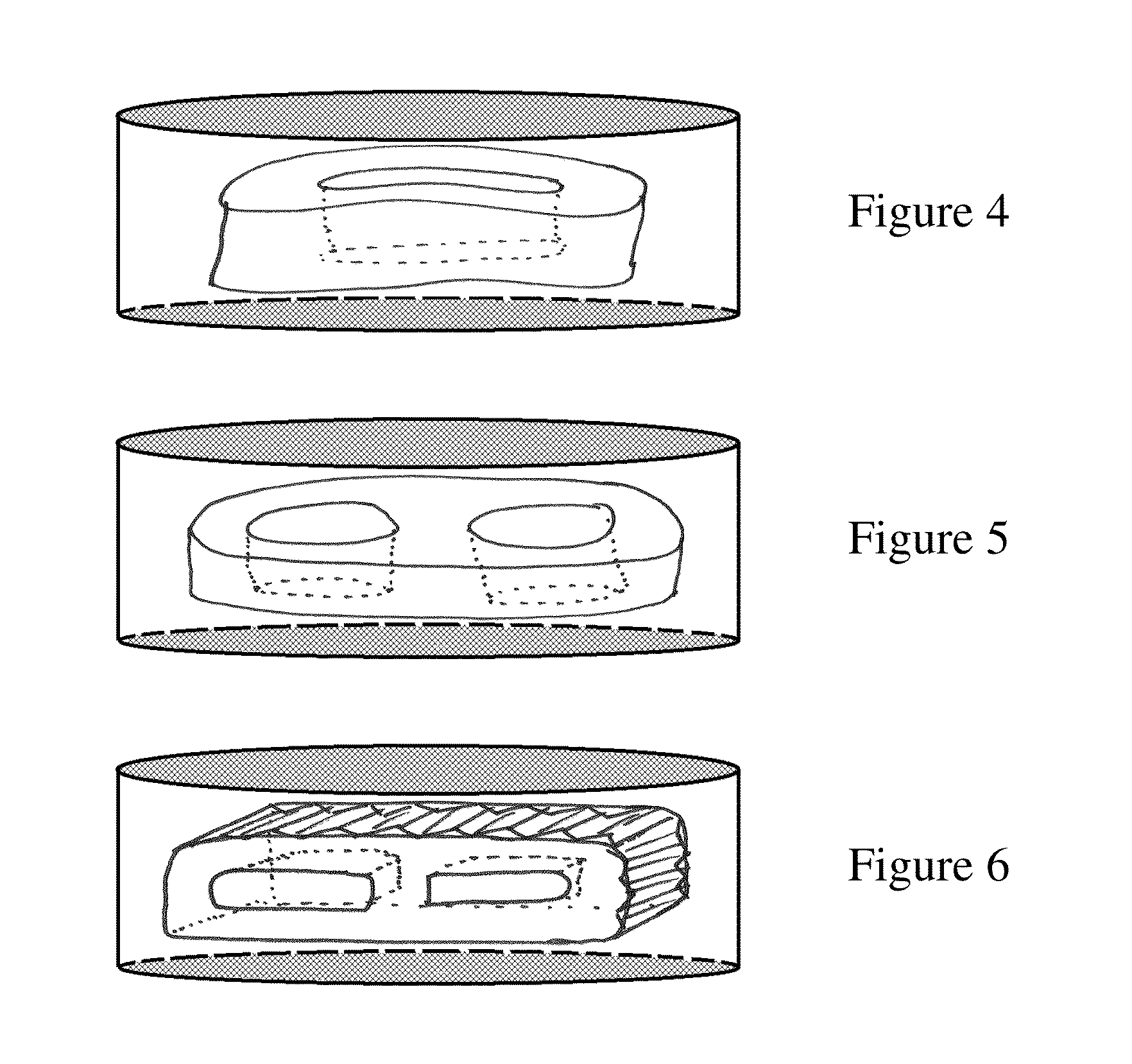 Sac for Use in Spinal Surgery