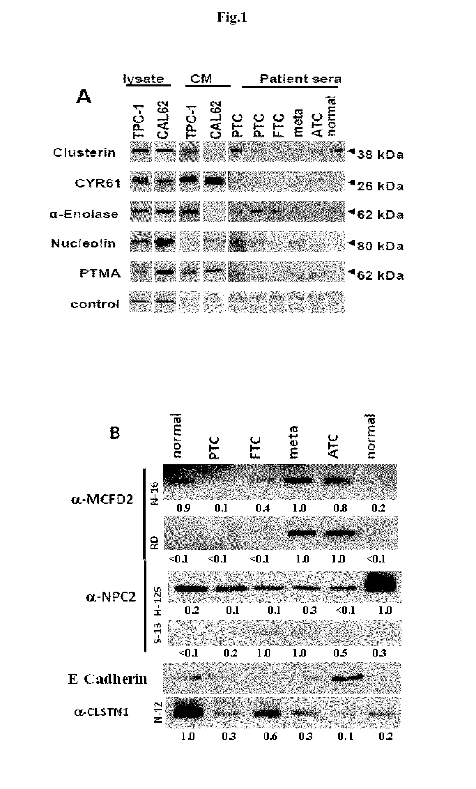 Methods and compositions for the diagnosis and treatment of thyroid cancer