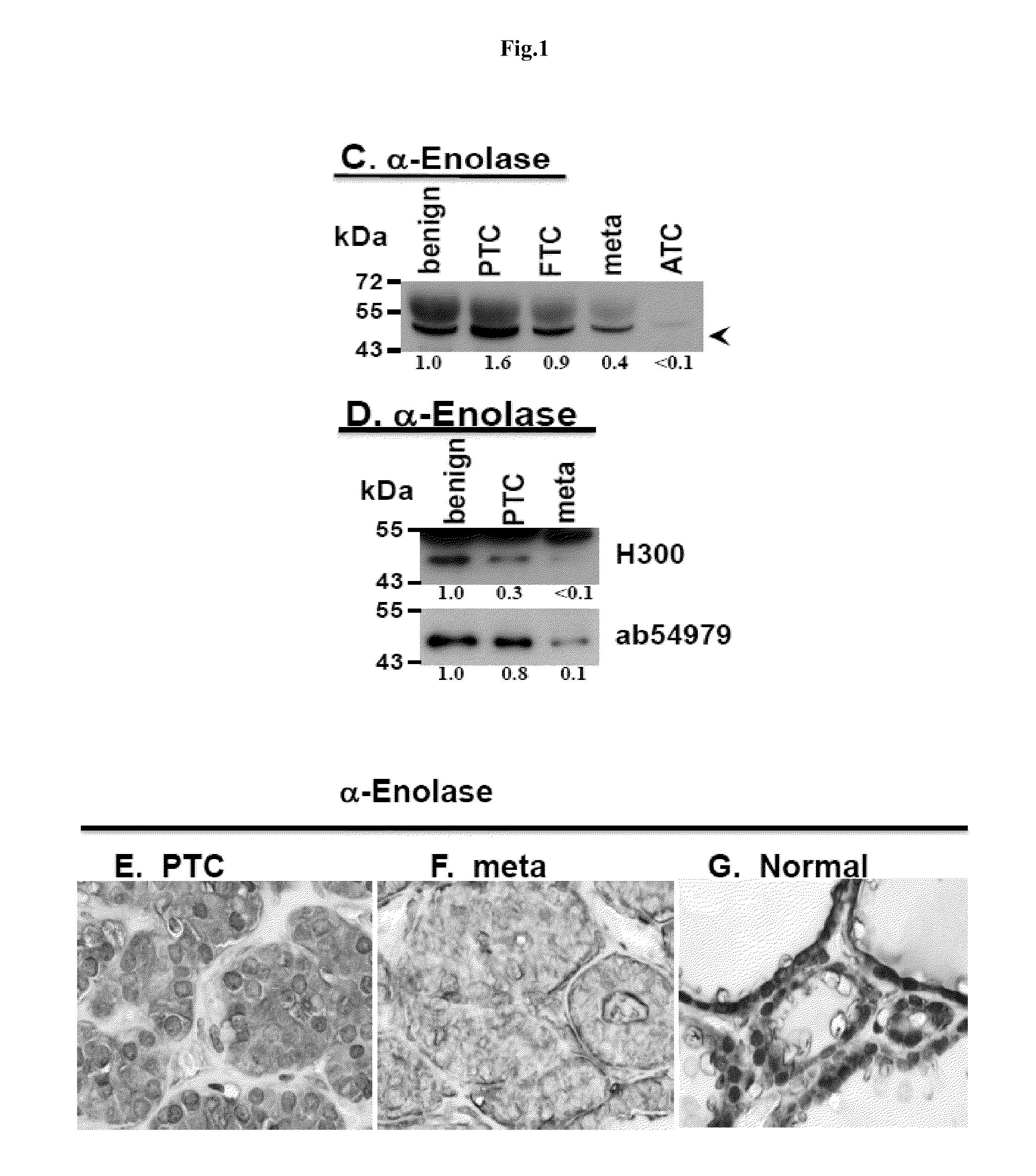 Methods and compositions for the diagnosis and treatment of thyroid cancer