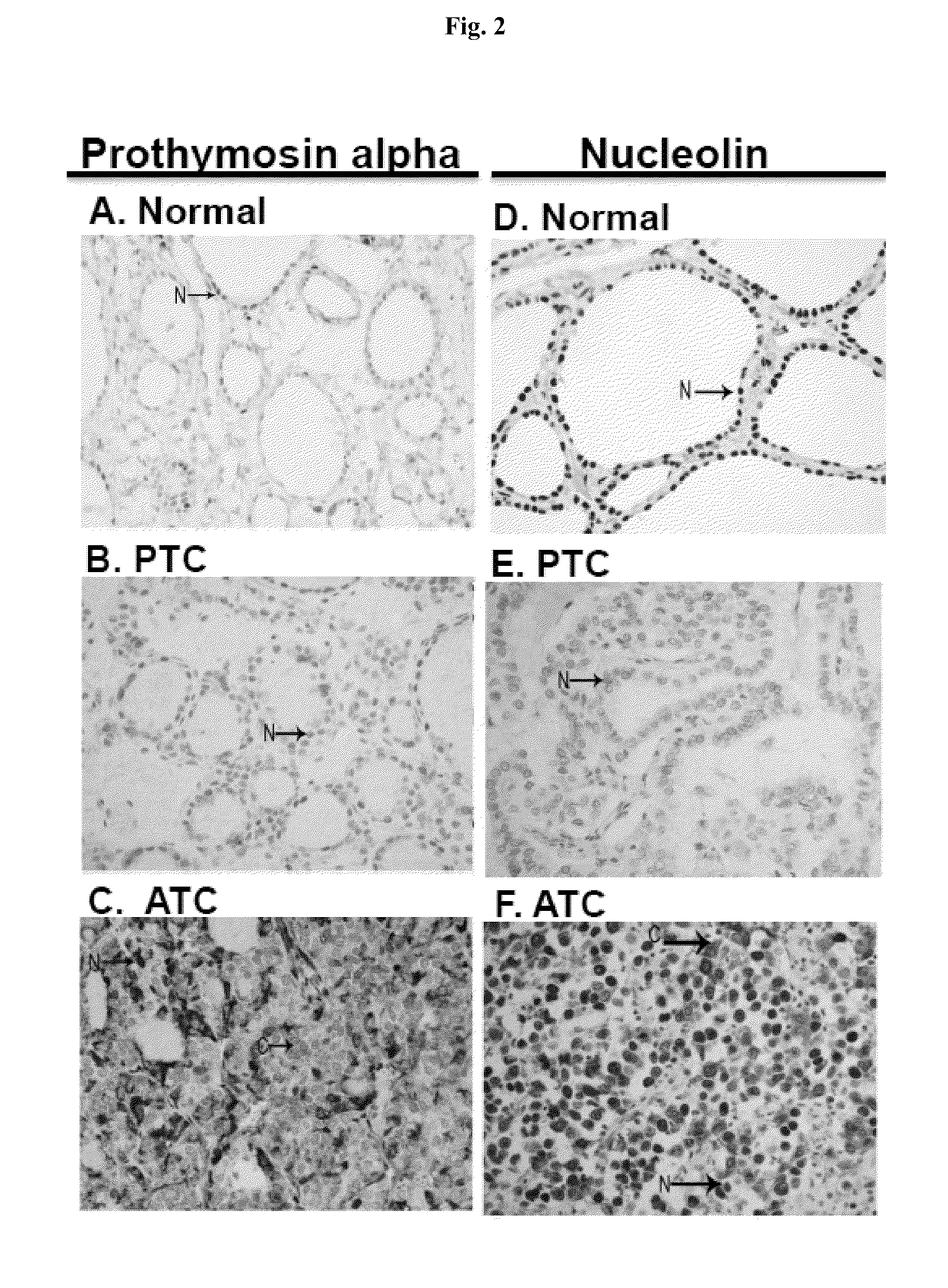 Methods and compositions for the diagnosis and treatment of thyroid cancer