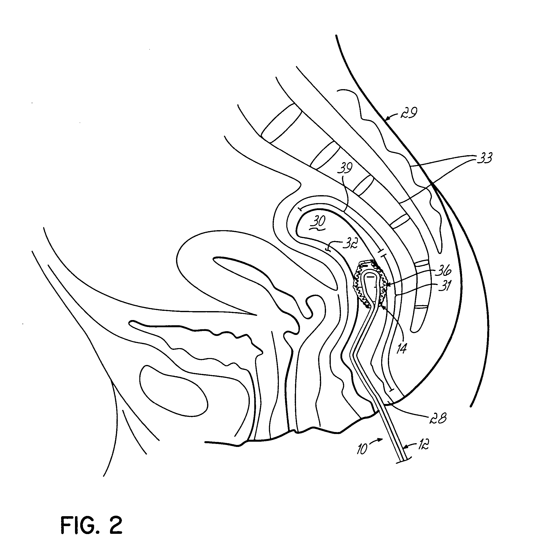 System and method using the rectal mucosal membrane for inducing hypothermia and warming