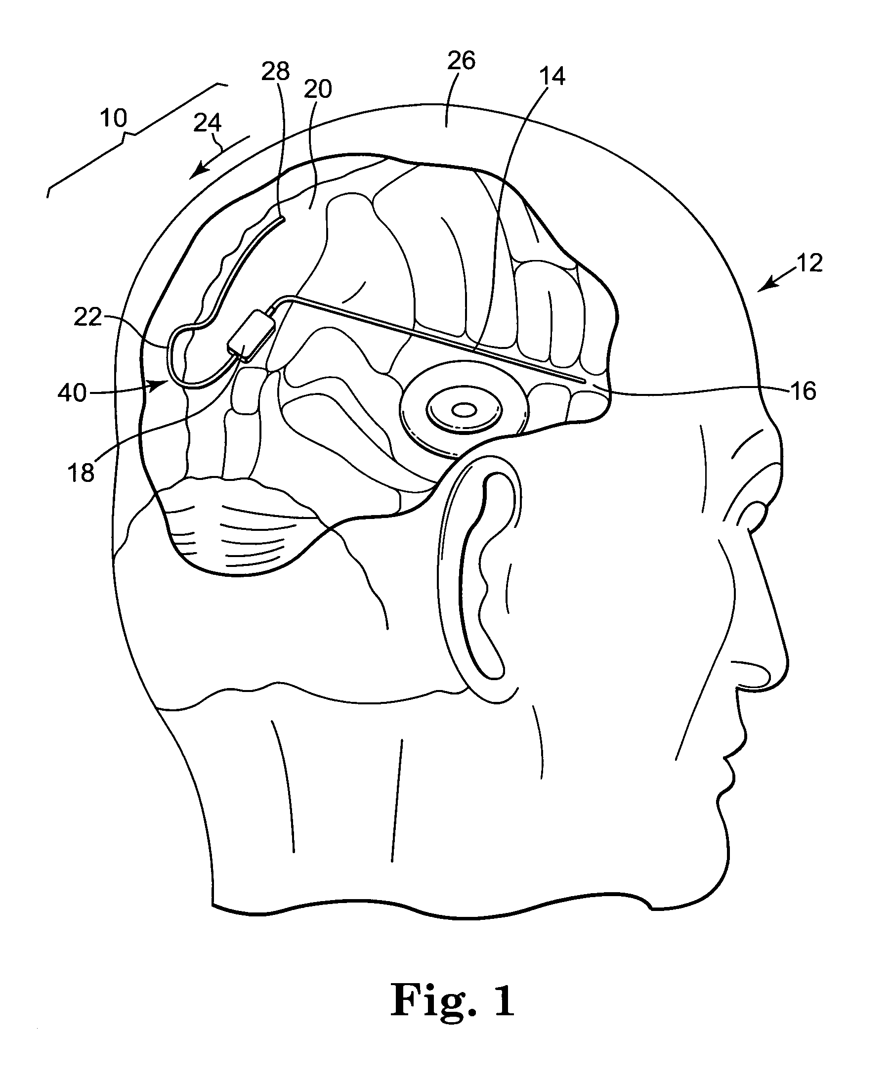 Apparatus and method for retrograde placement of sagittal sinus drainage catheter