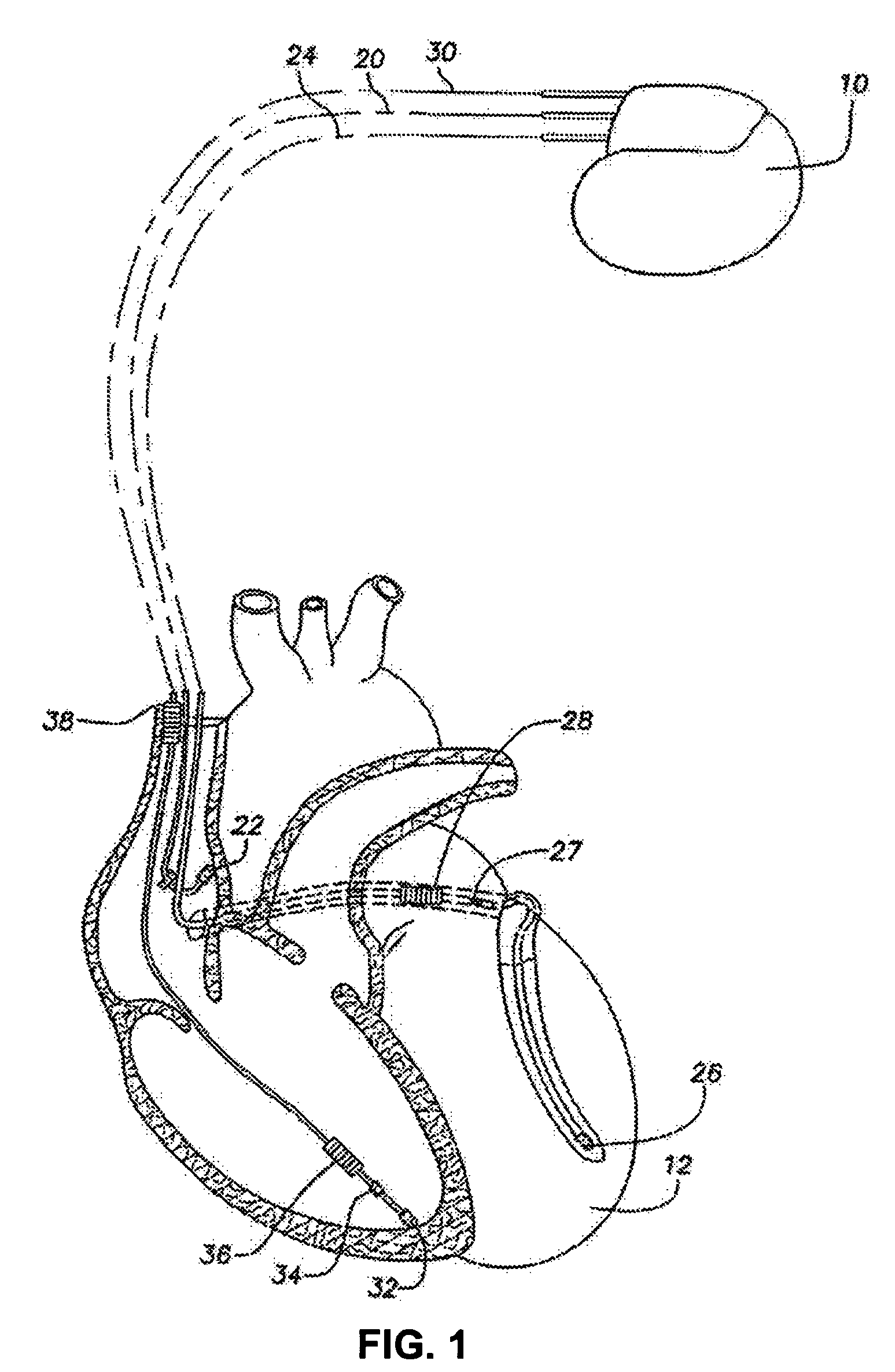 Reconfigurable digital network for processing data in an implantable medical device