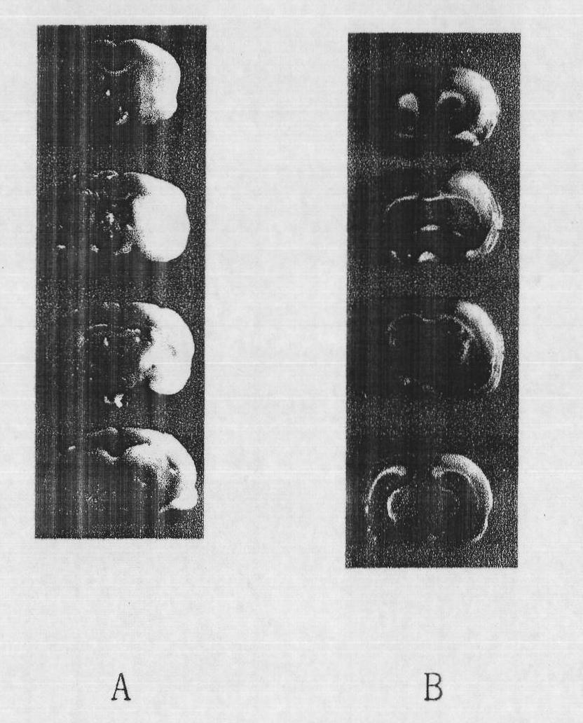 Bilobalide with aquaporin regulating effect and new use of derivative thereof in treating encephaledema