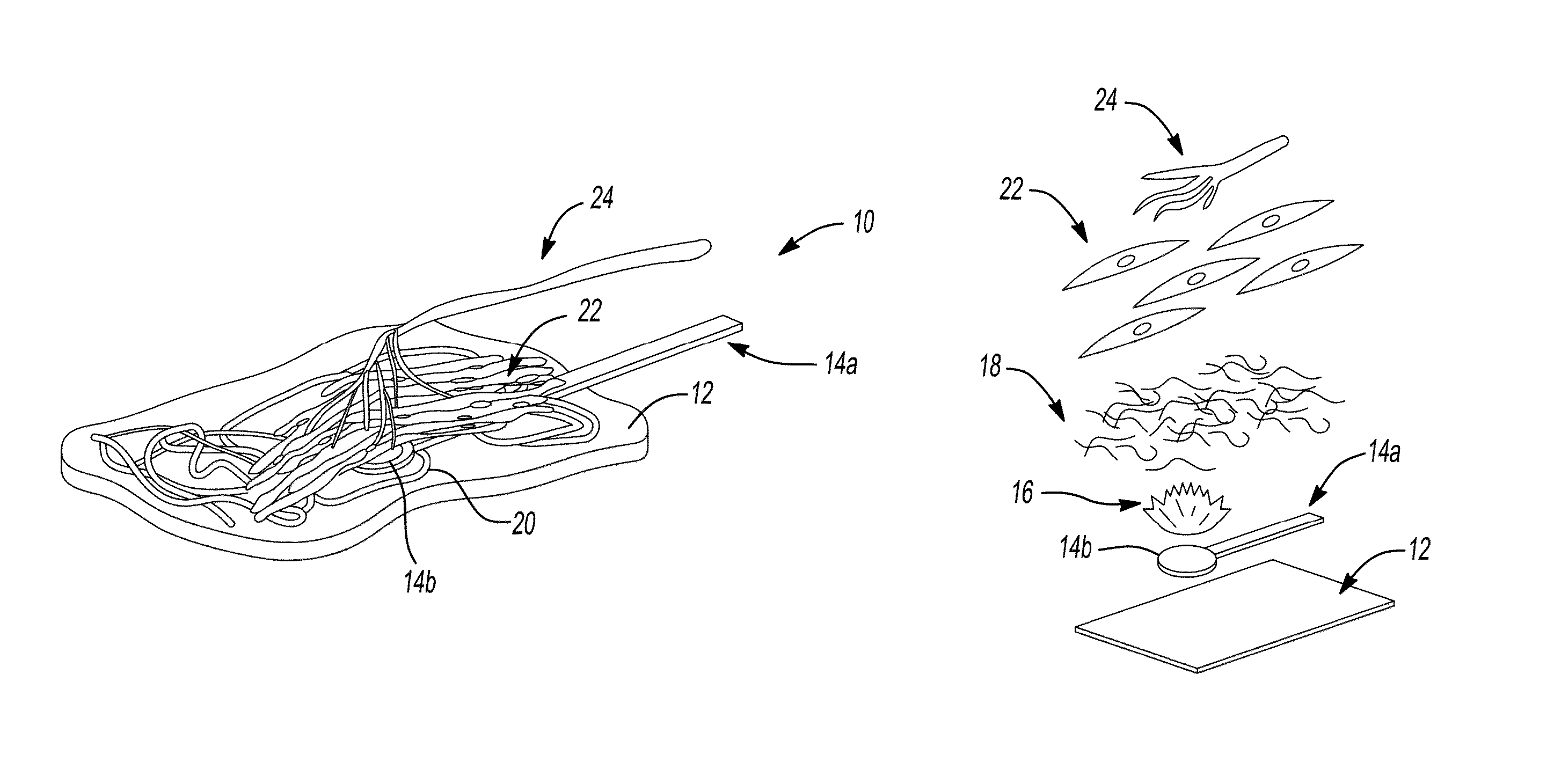 Peripheral nerve interface devices for treatment and prevention of neuromas