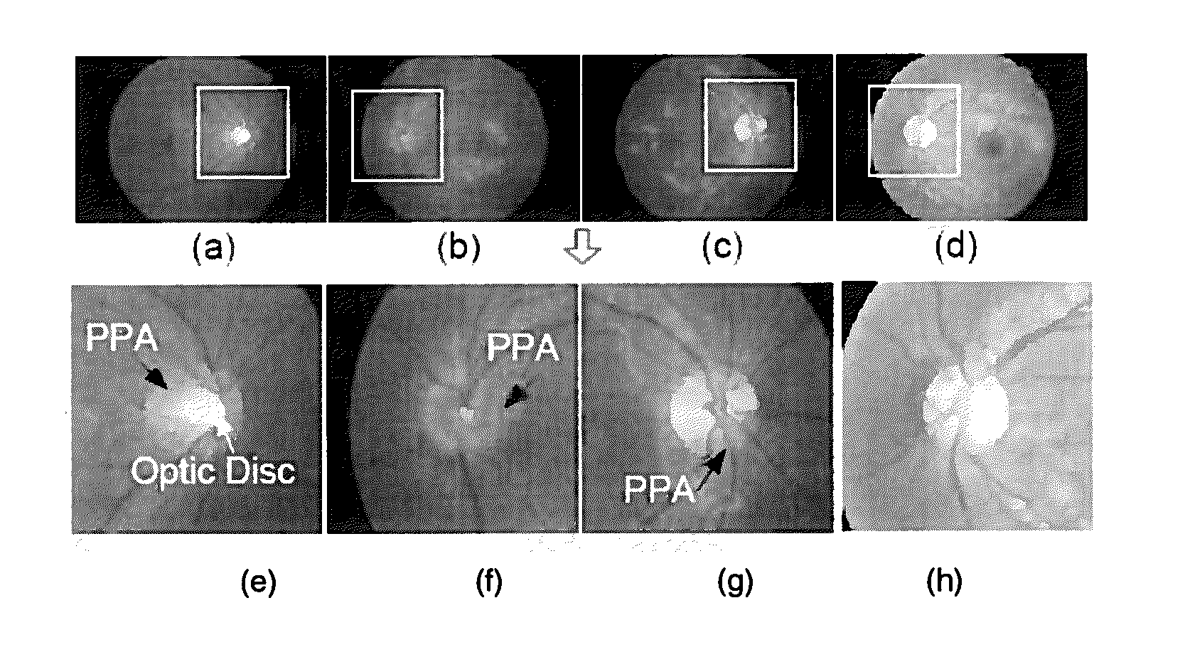 Methods and systems for detecting peripapillary atrophy