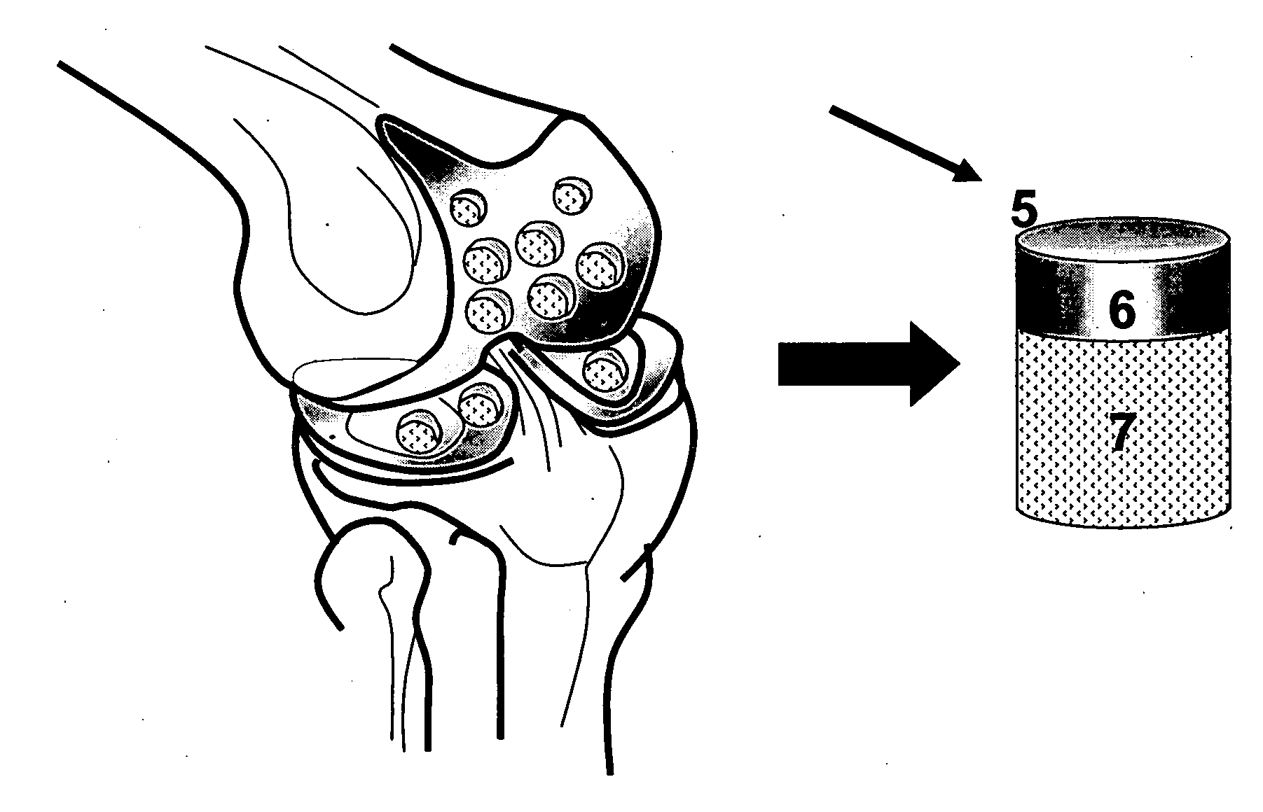 Cleaning and devitalization of cartilage