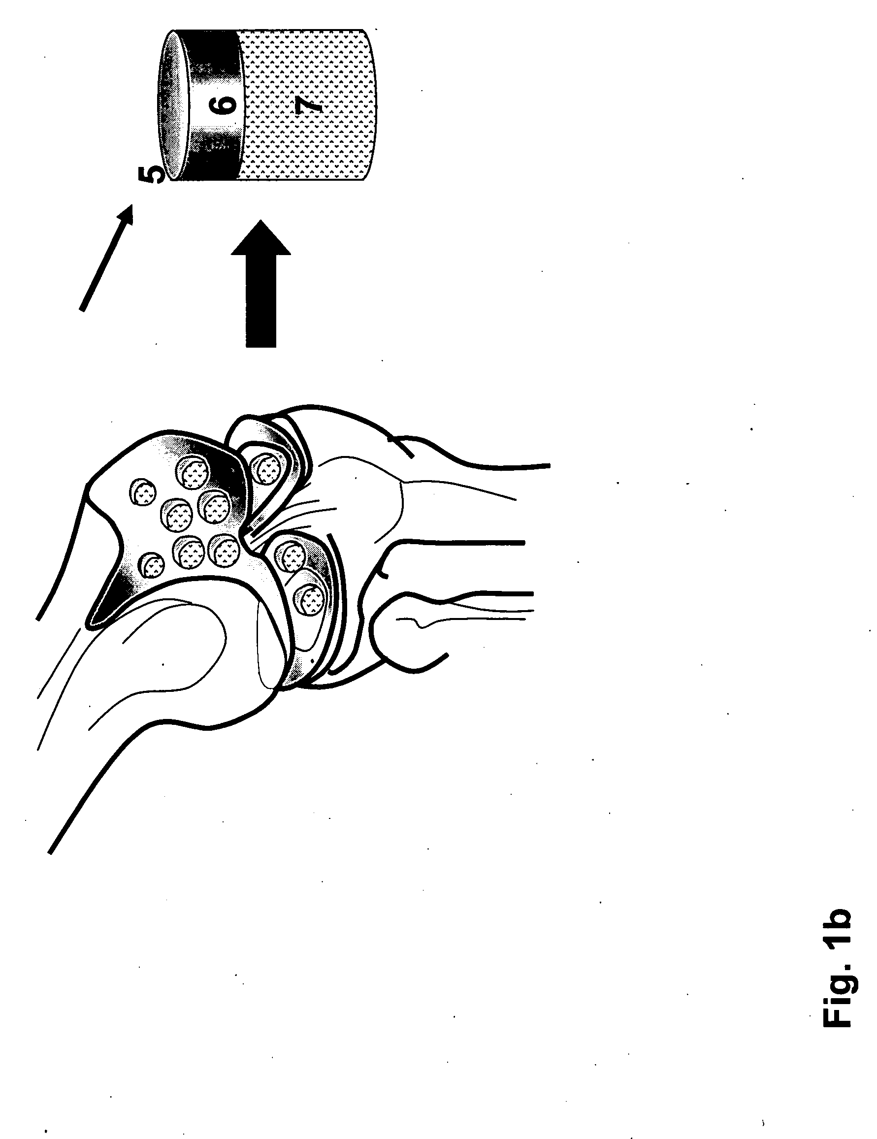 Cleaning and devitalization of cartilage