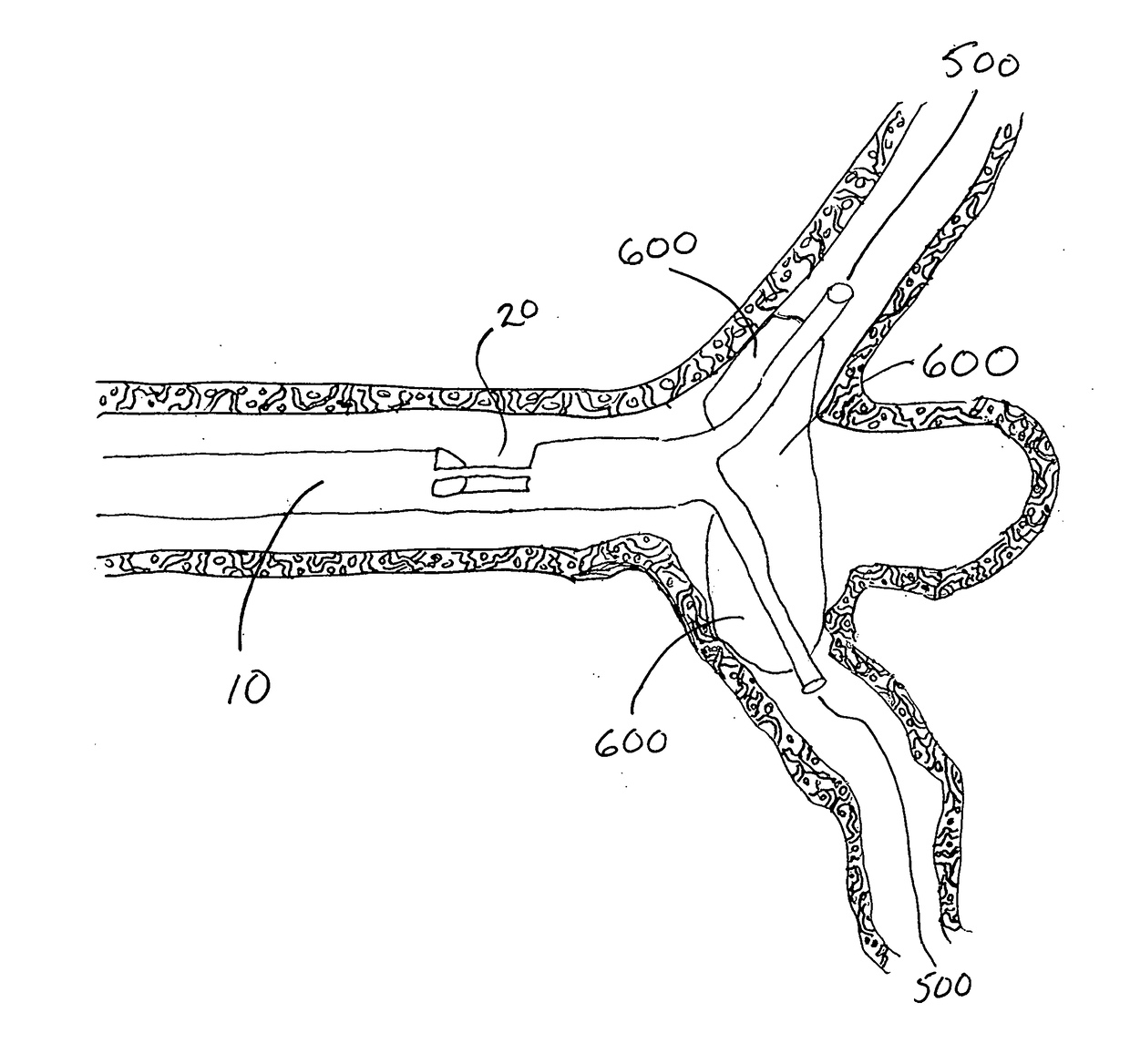 Temporary bypass balloon catheter