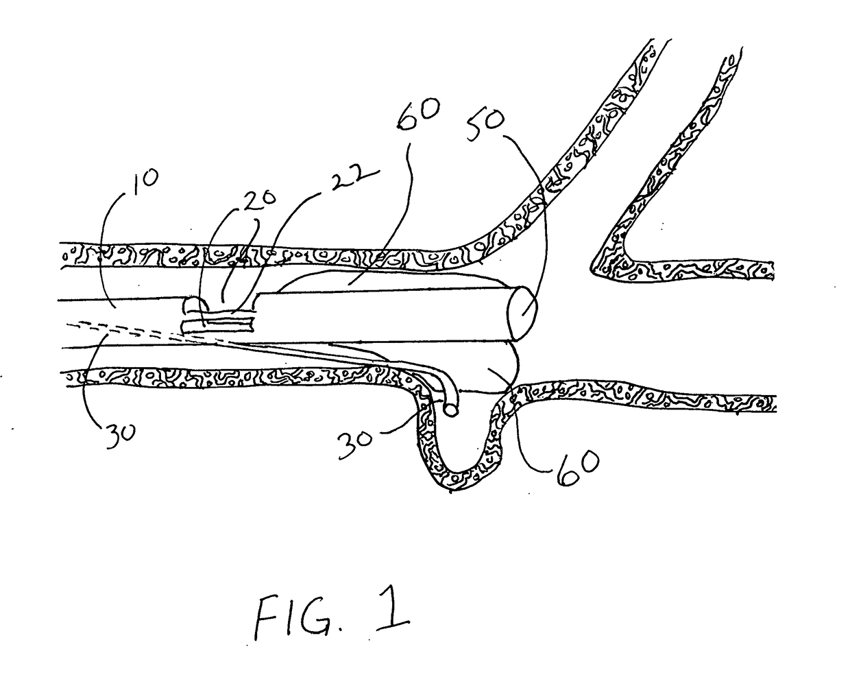 Temporary bypass balloon catheter