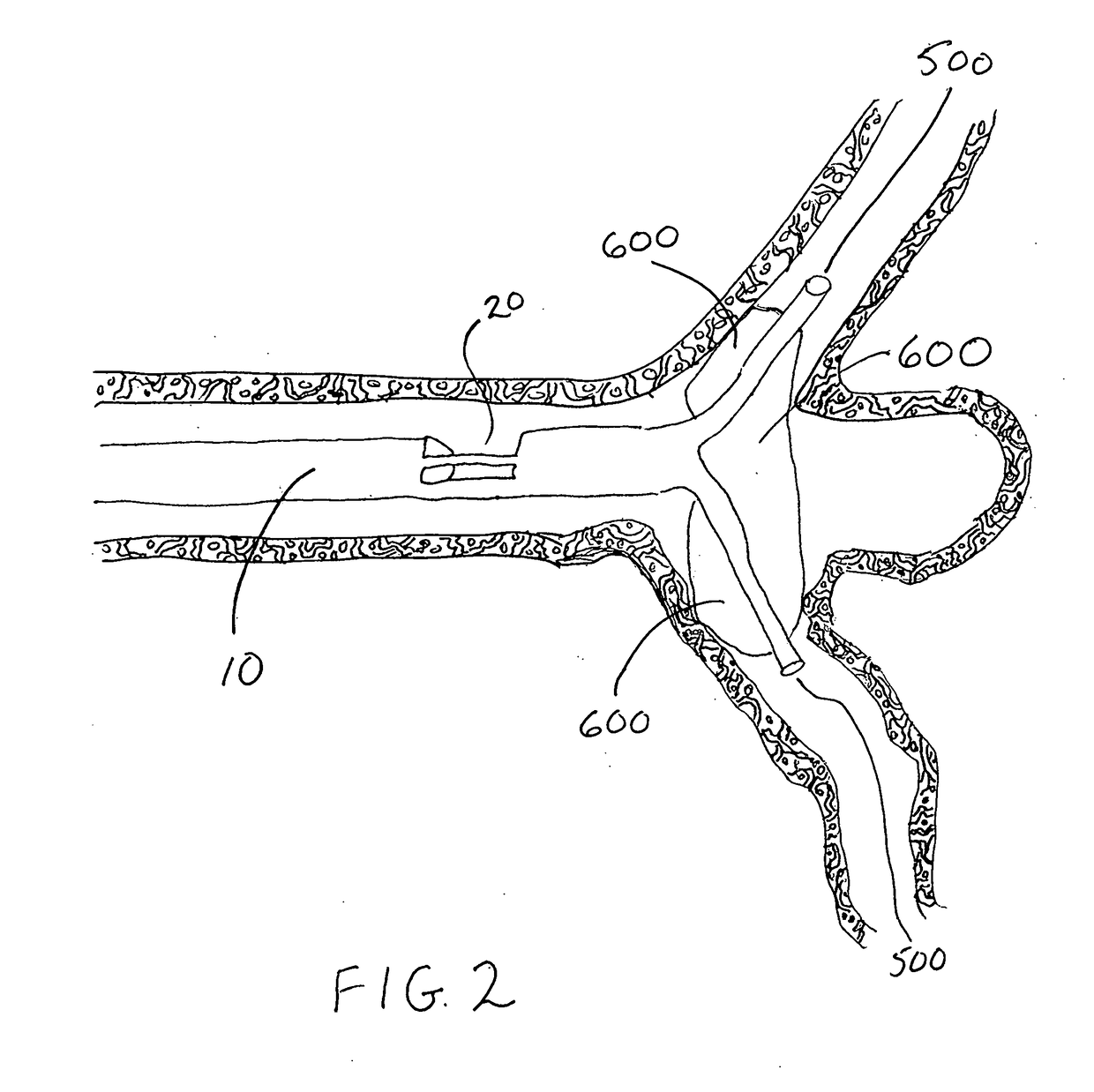 Temporary bypass balloon catheter