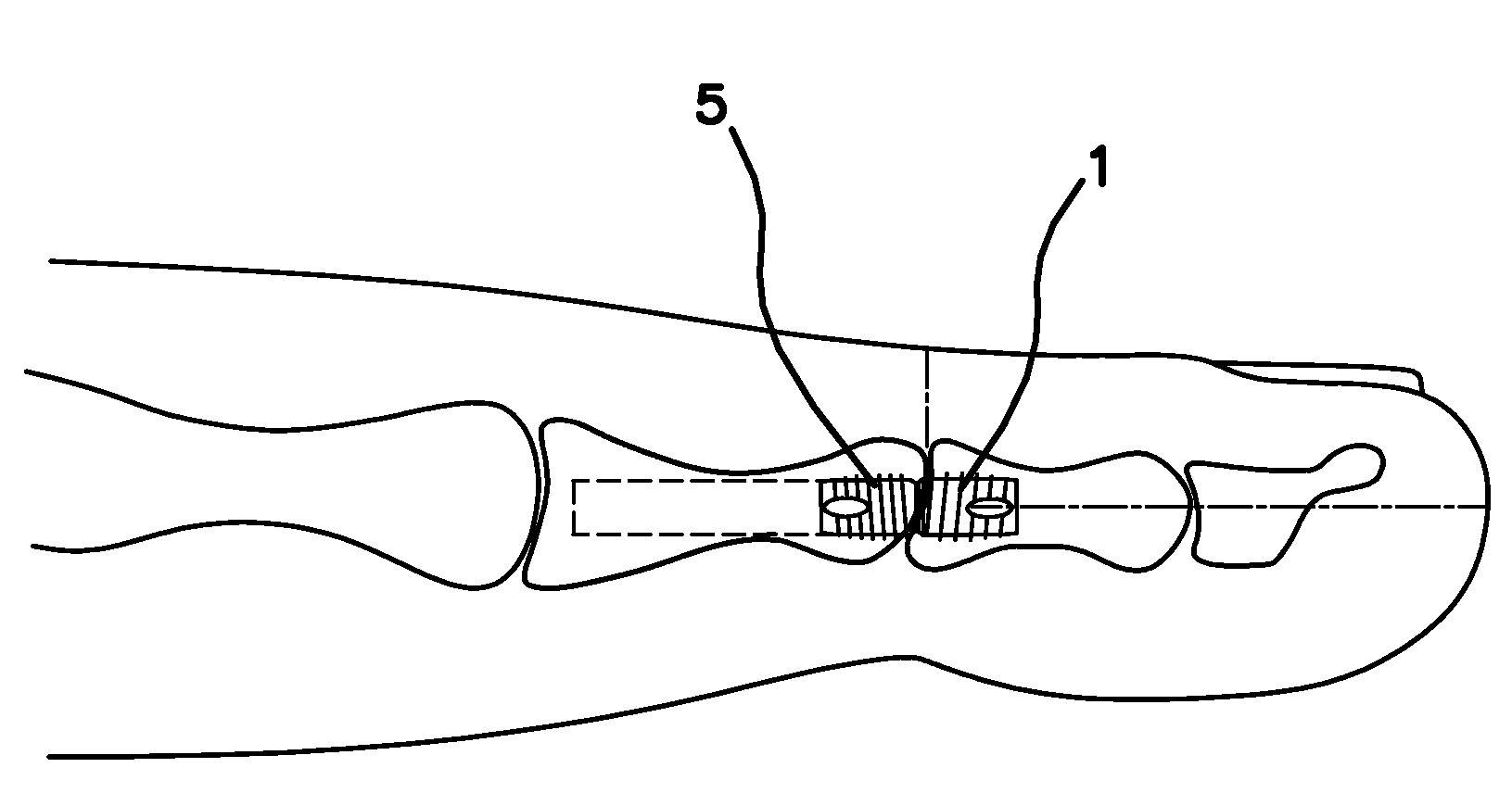 Apparatus and Method for Use in the Treatment of Hammertoe