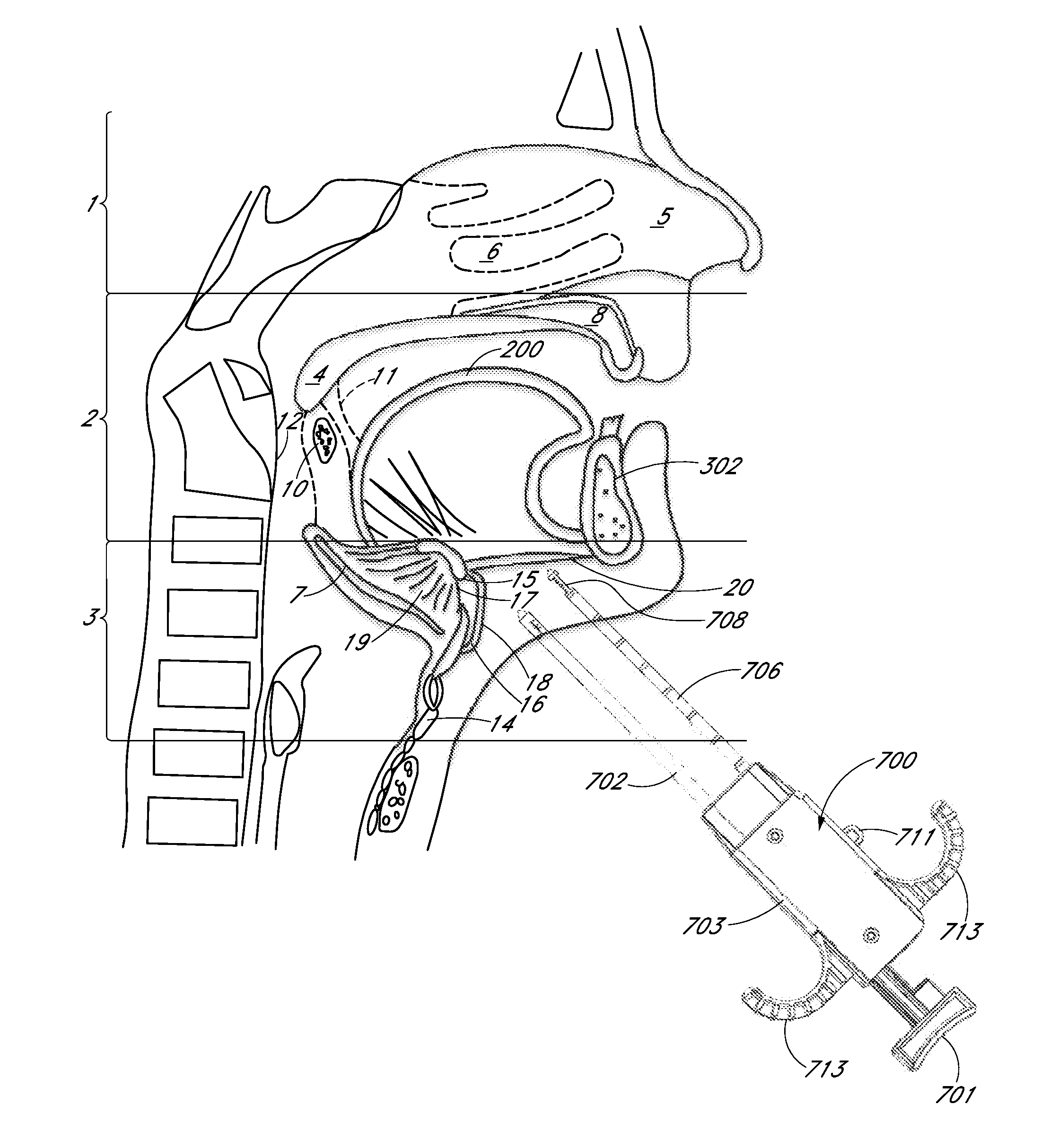 Suture passer systems and methods for tongue or other tissue suspension and compression