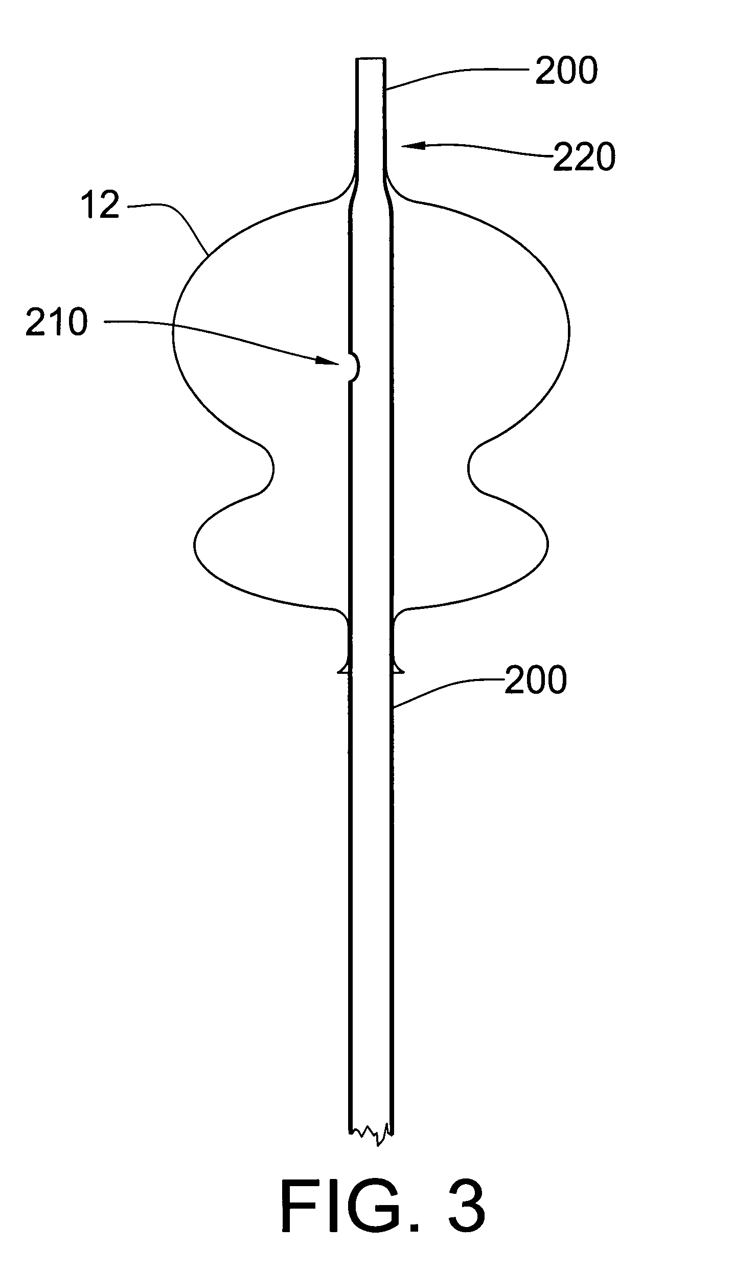 Over-the-wire exclusion device and system for delivery