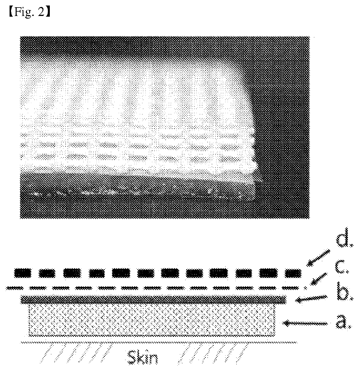 Pad for alleviating and treating plasma protein exudation skin diseases including atopic diseases