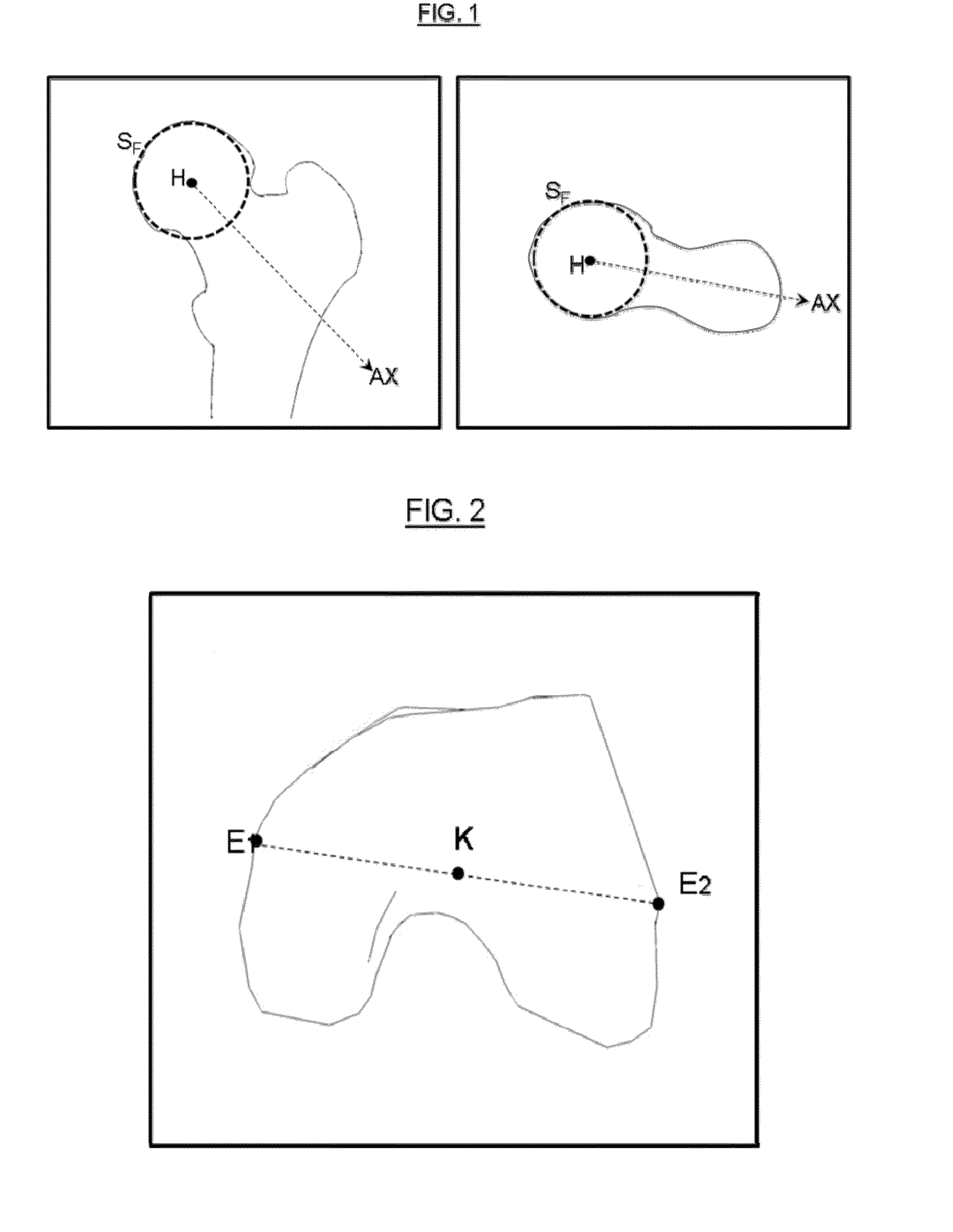 Method for determining articular bone deformity resection using motion patterns