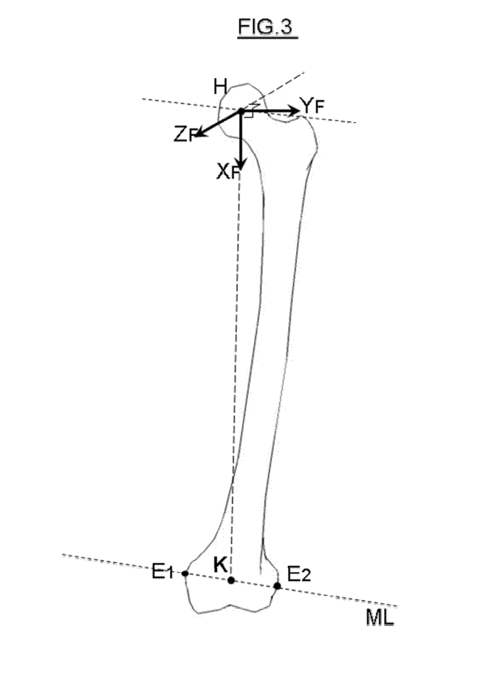 Method for determining articular bone deformity resection using motion patterns